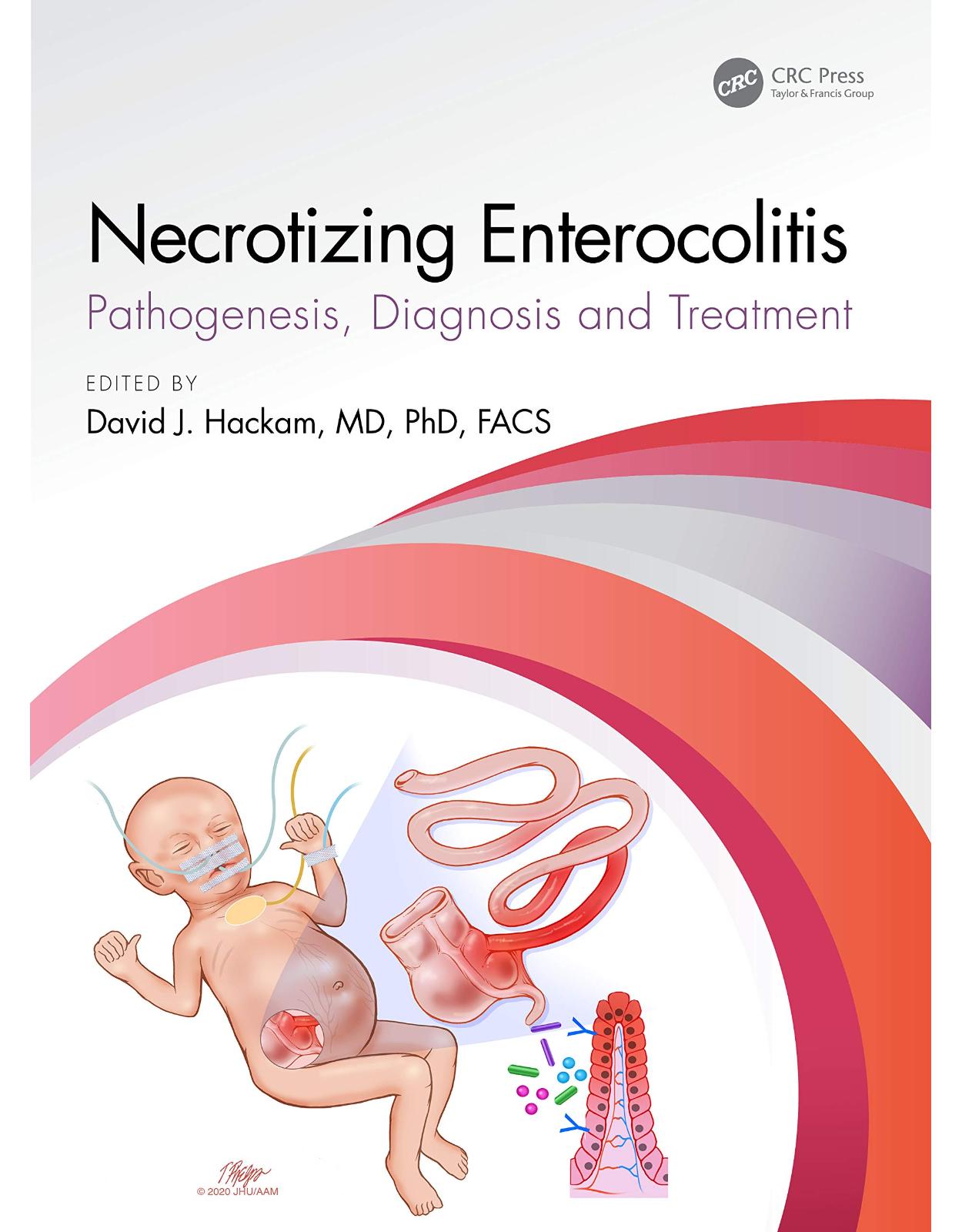 Necrotizing Enterocolitis