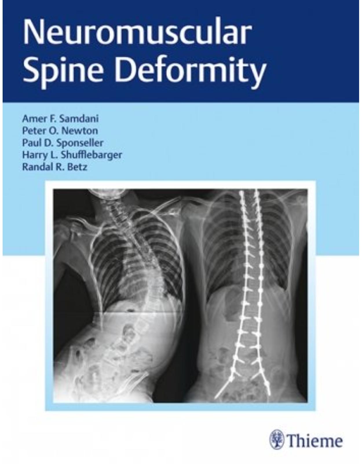  Neuromuscular Spine Deformity