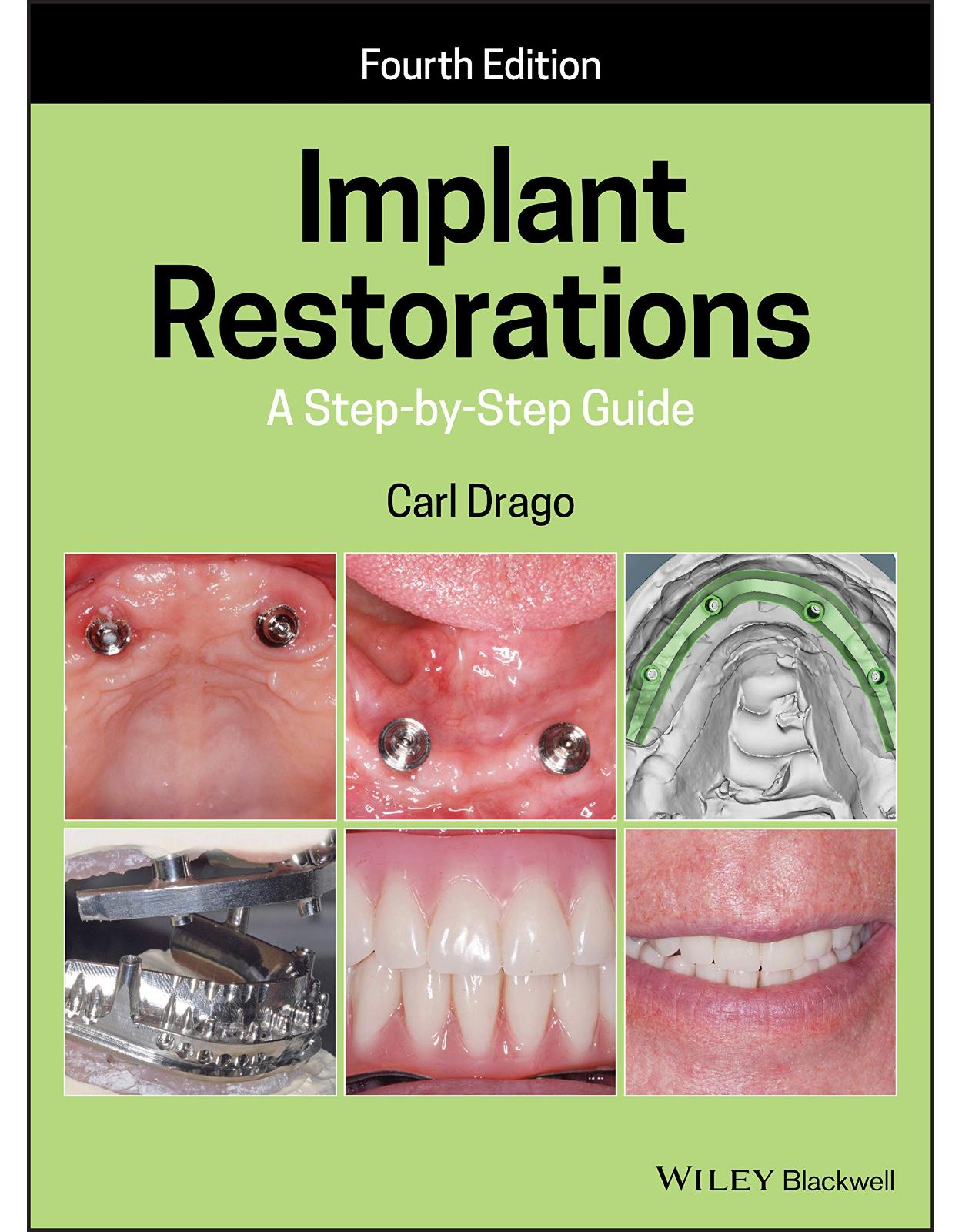 Implant Restorations: A Step-by-Step Guide