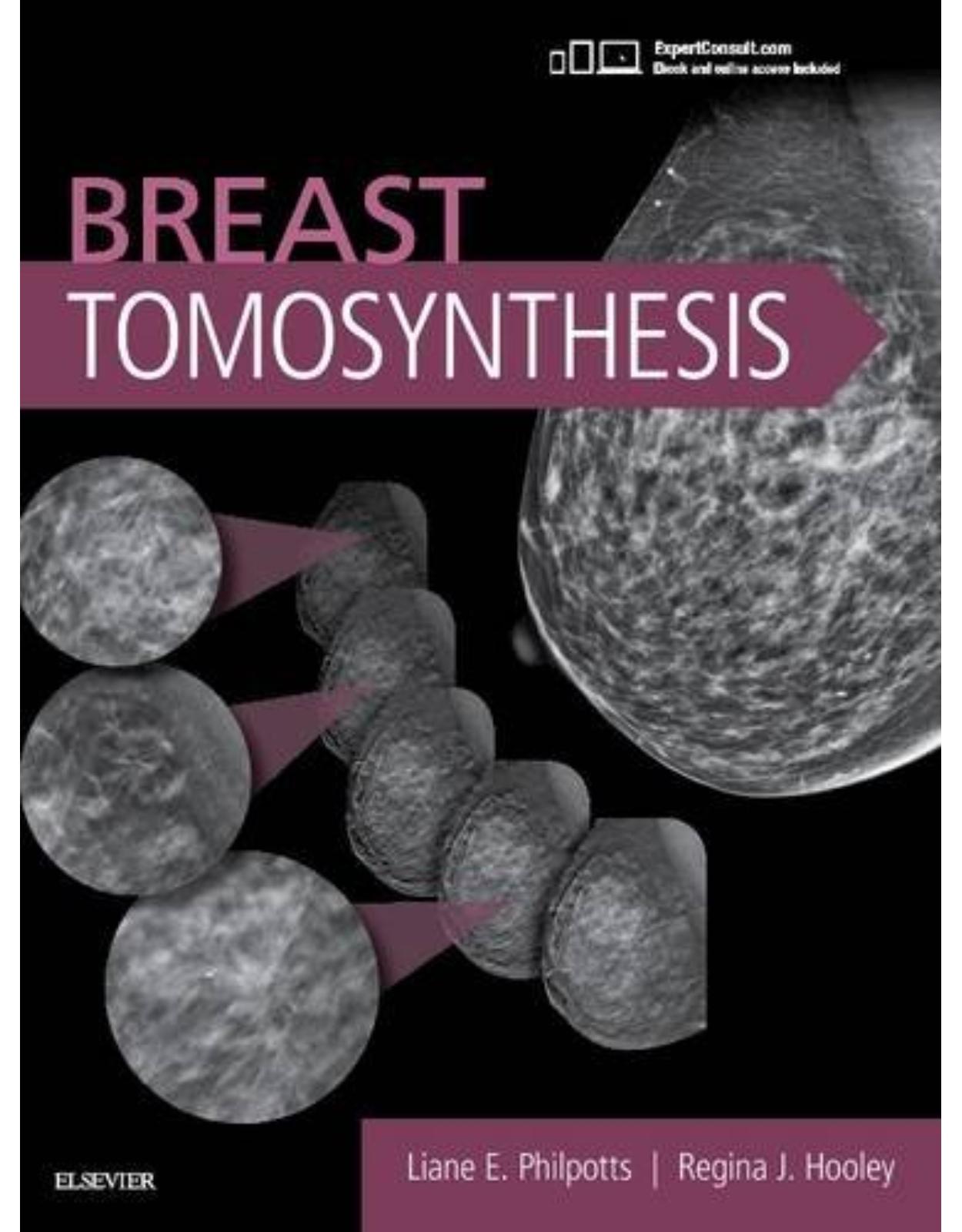 Breast Tomosynthesis