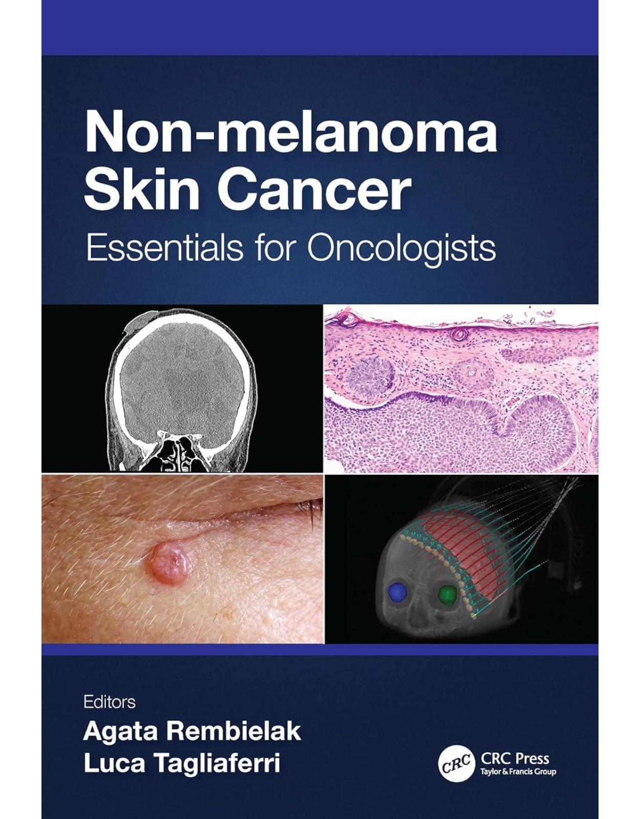 Non-melanoma Skin Cancer. Essentials for Oncologists