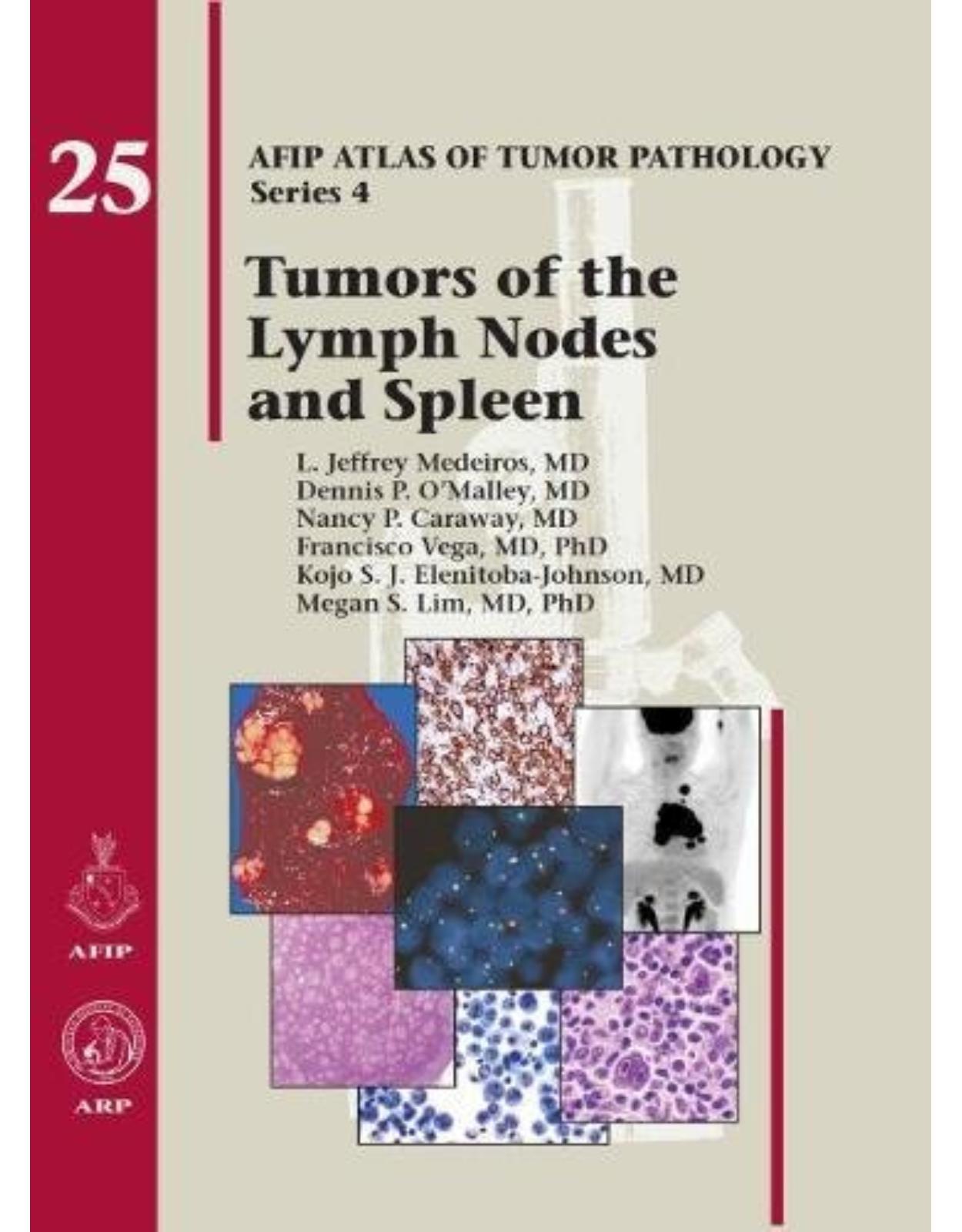 Tumors of the Lymph Node and Spleen