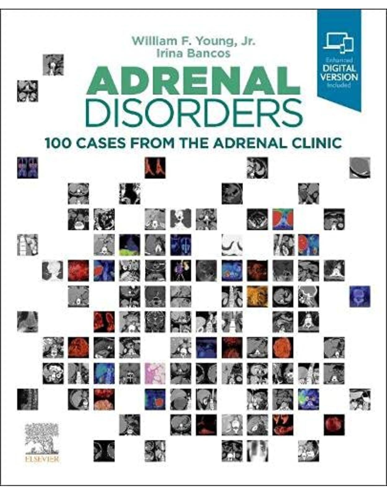 Adrenal Disorders: 100 Cases from the Adrenal Clinic 
