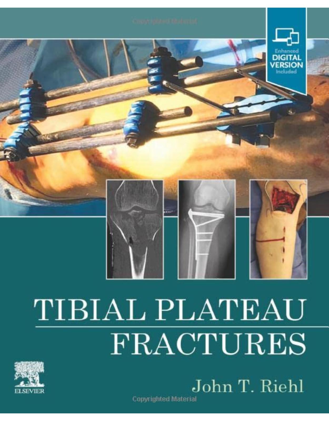 Tibial Plateau Fractures 