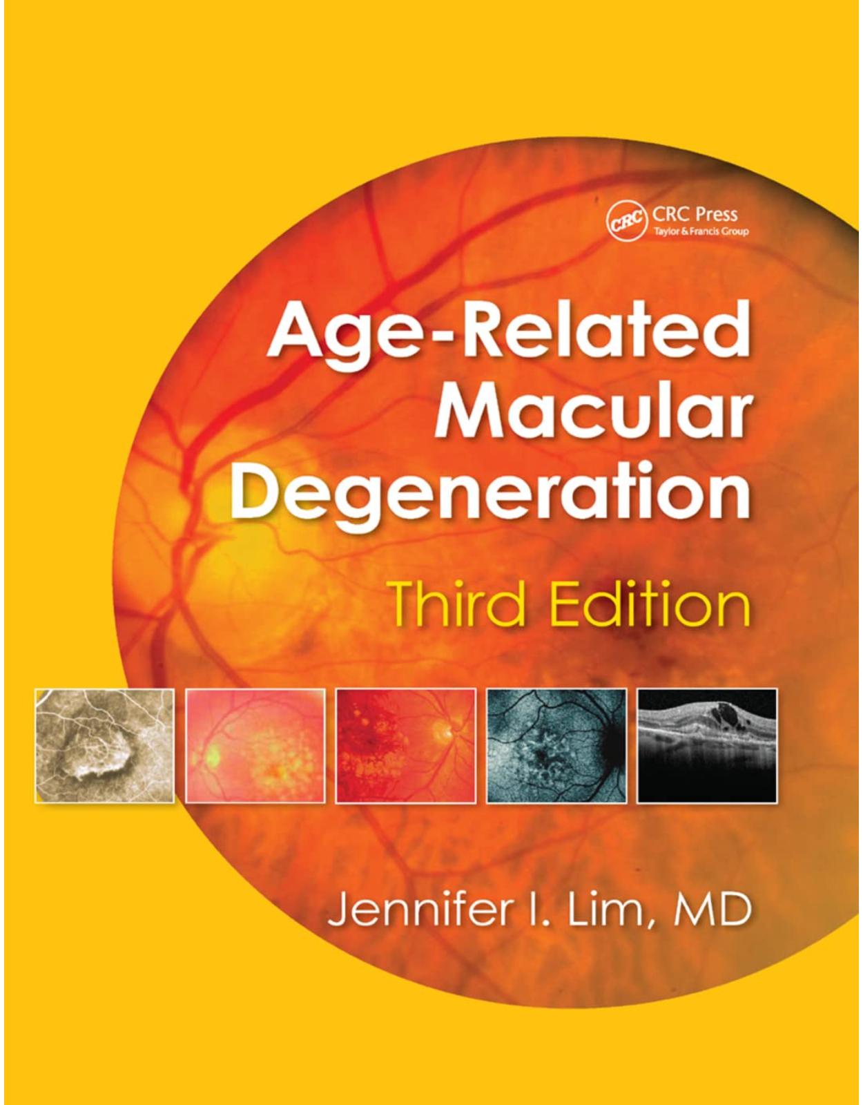 Age-Related Macular Degeneration