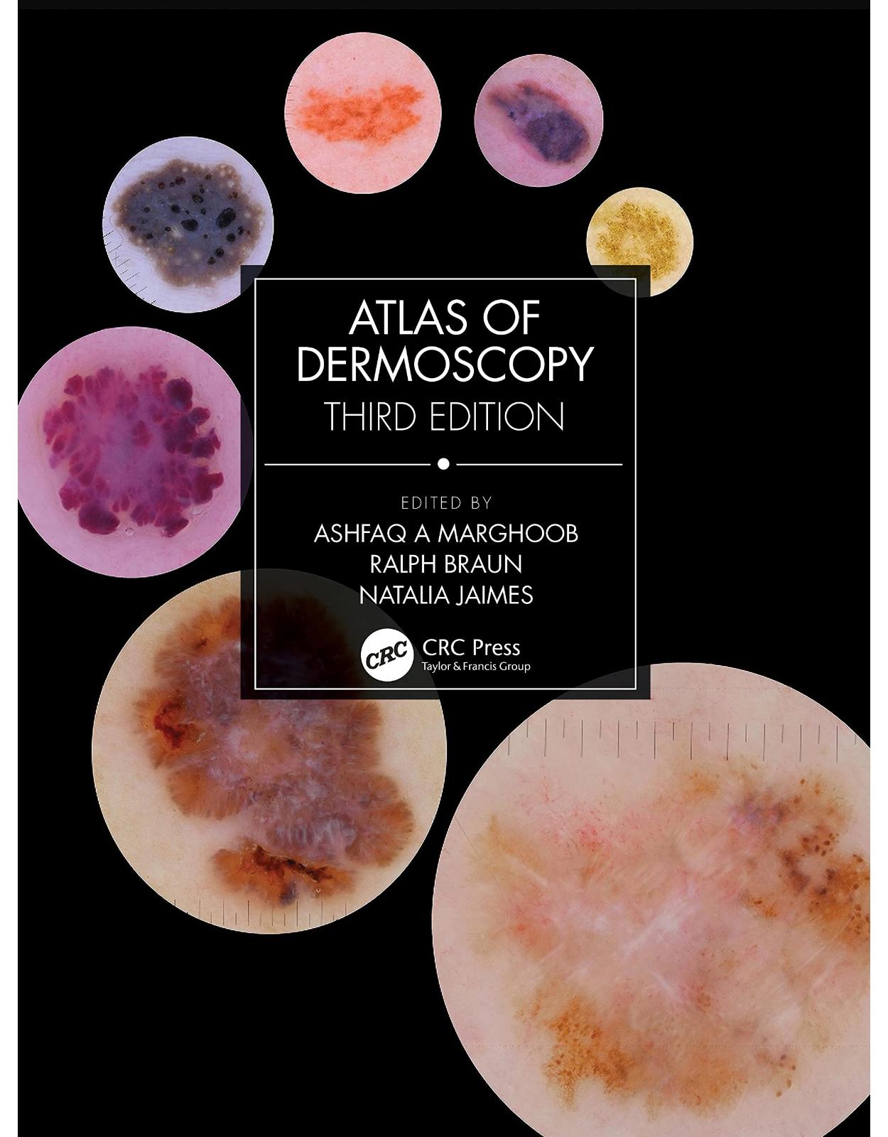 Atlas of Dermoscopy: Third Edition