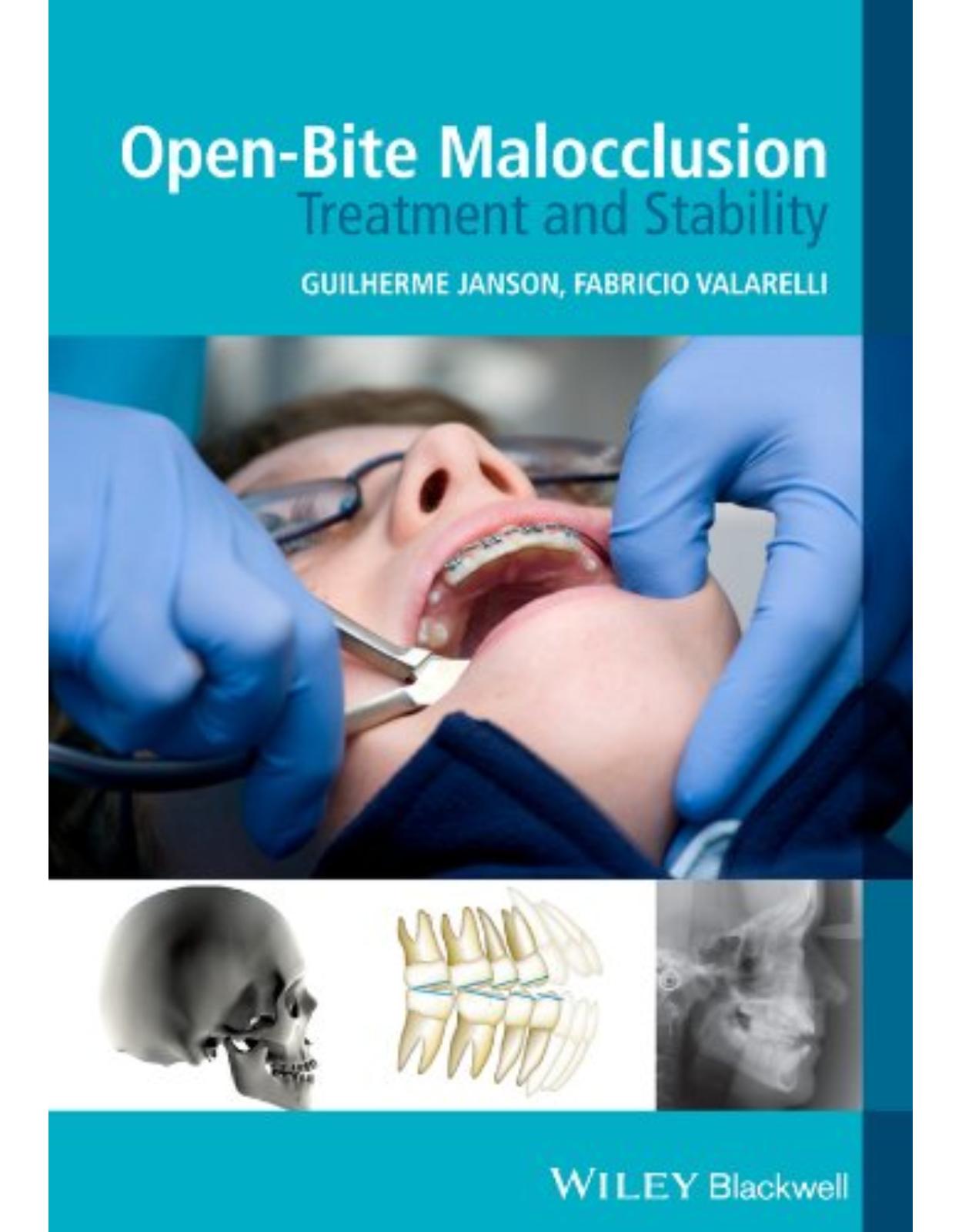 Open–Bite Malocclusion – Treatment and Stability