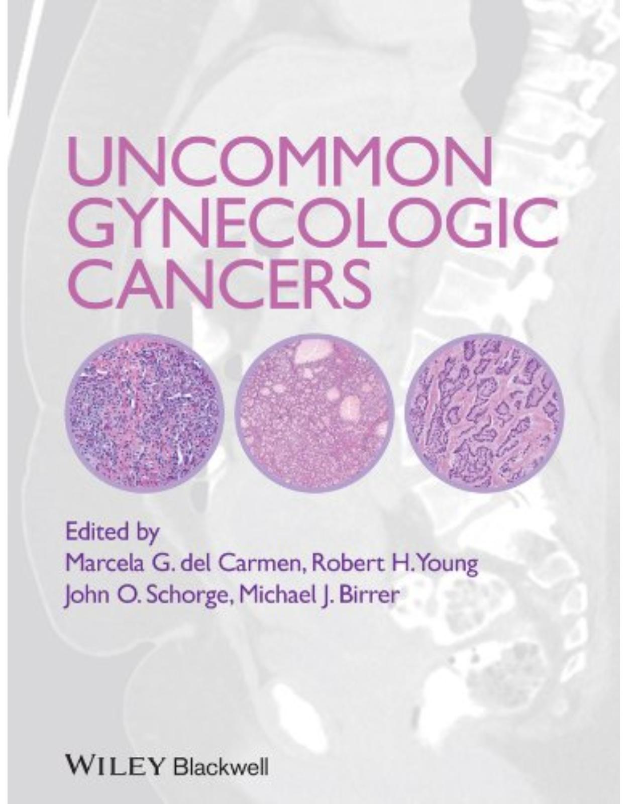 Uncommon Gynecologic Cancers 