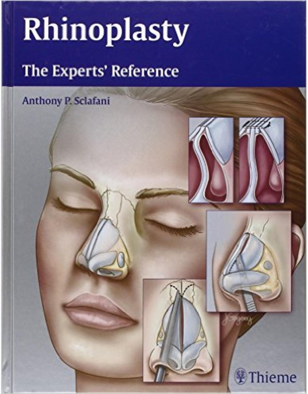 Rhinoplasty: The Experts' Reference 1st Edition
