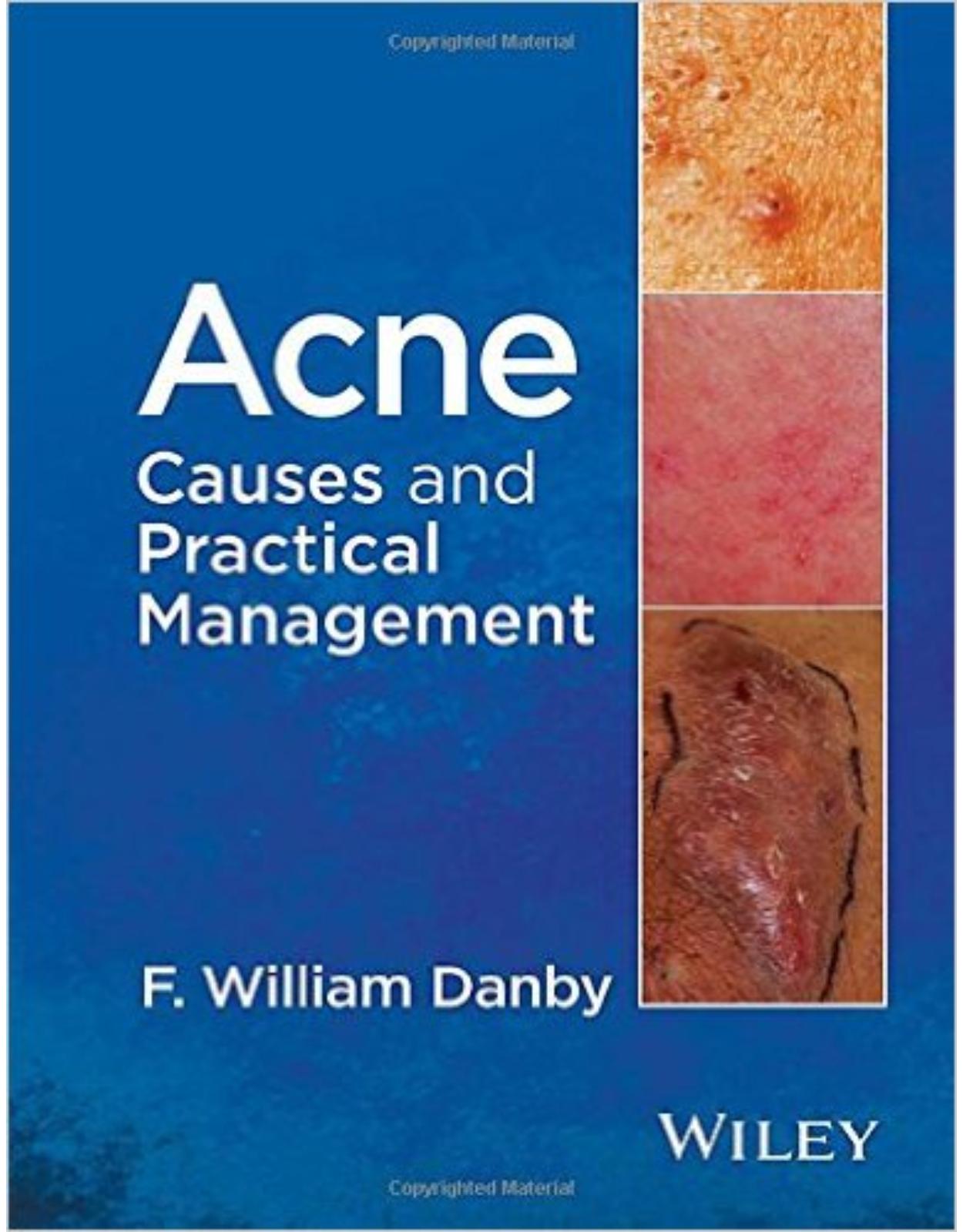 Acne: Causes and Practical Management 1st Edition