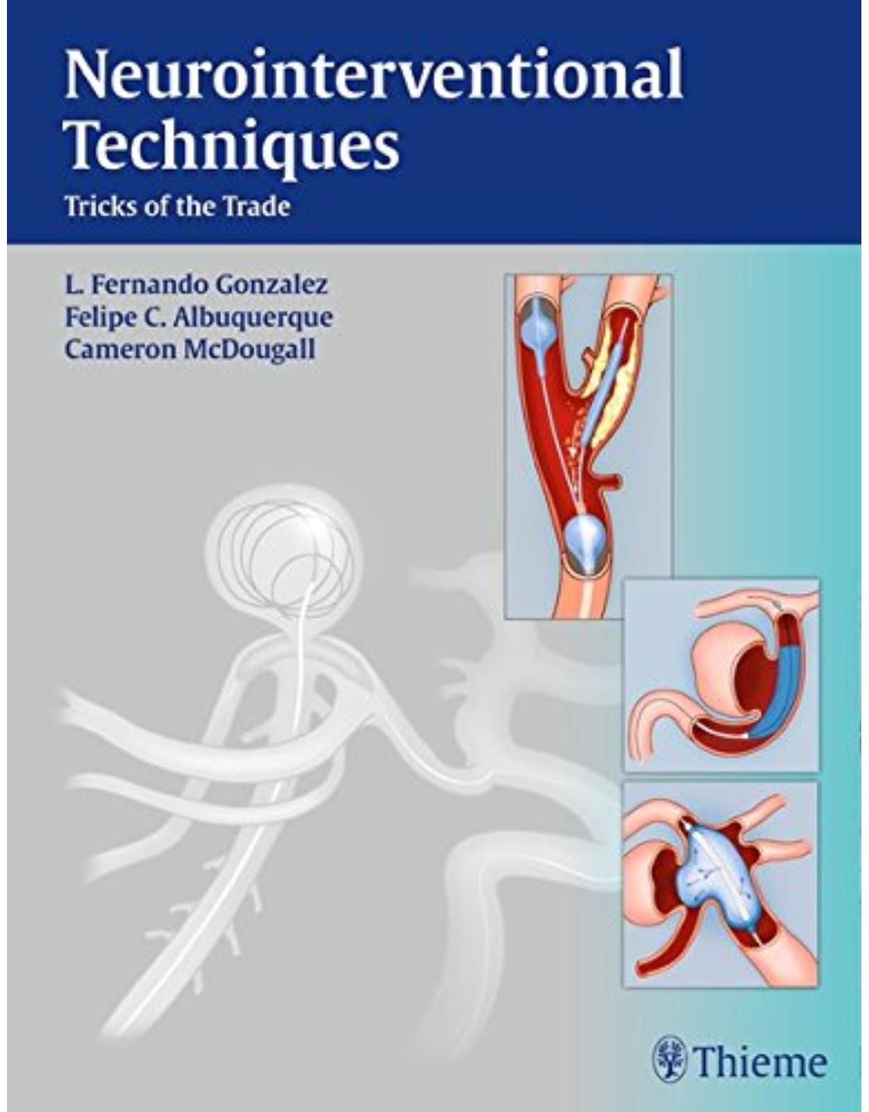 Neurointerventional TechniquesTricks of the Trade