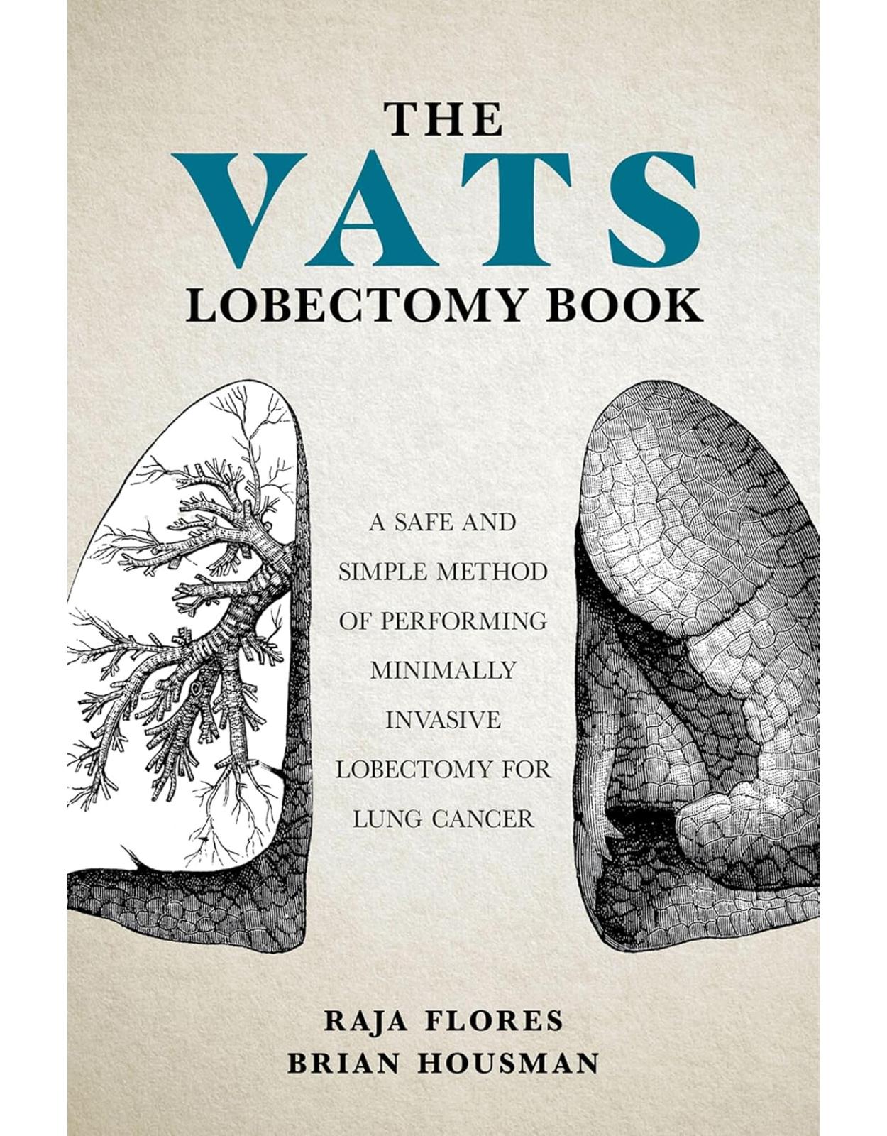 The VATS Lobectomy Book. A Safe and Simple Method of Performing Minimally Invasive Lobectomy for Lung Cancer