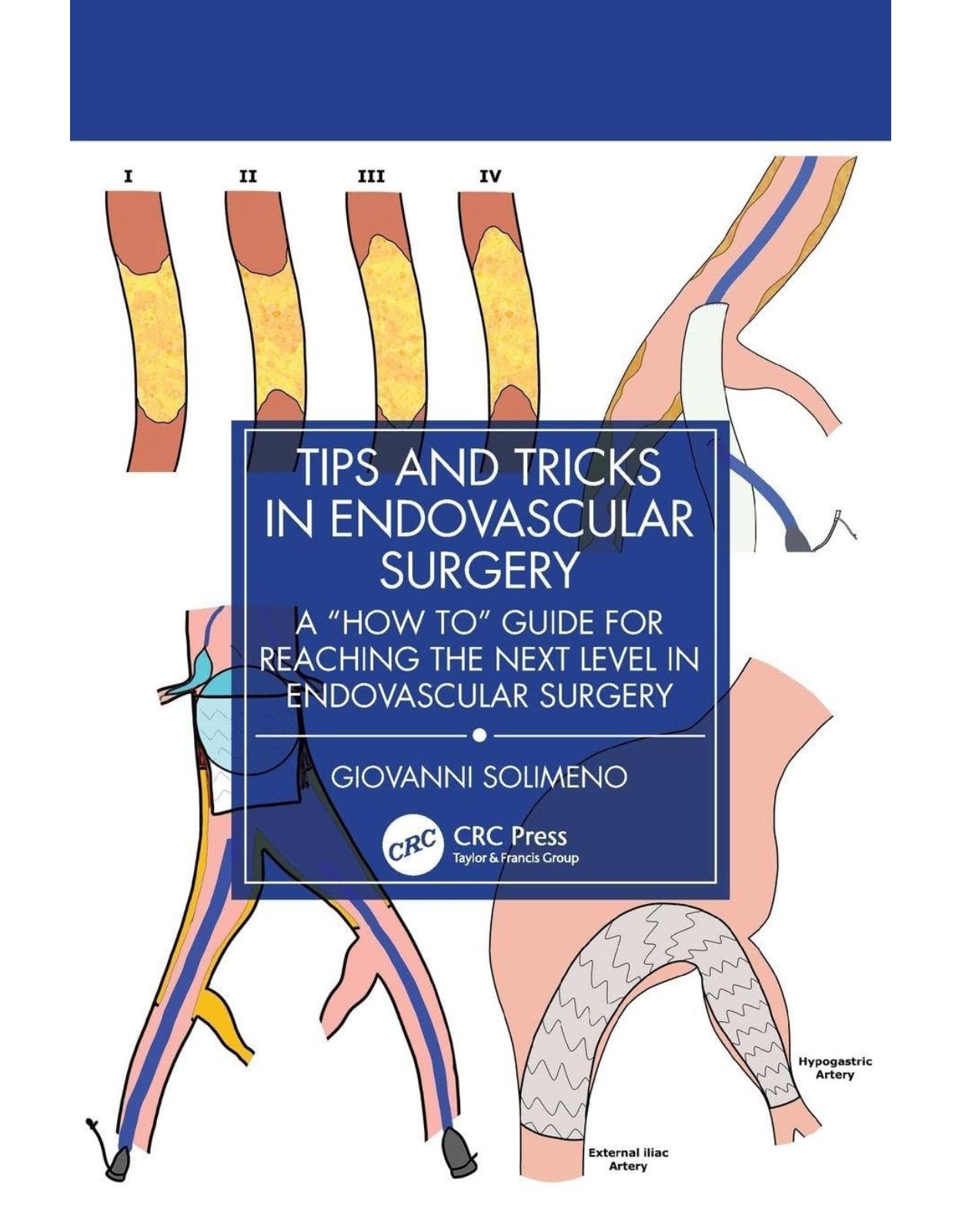 Tips and Tricks in Endovascular Surgery. A 