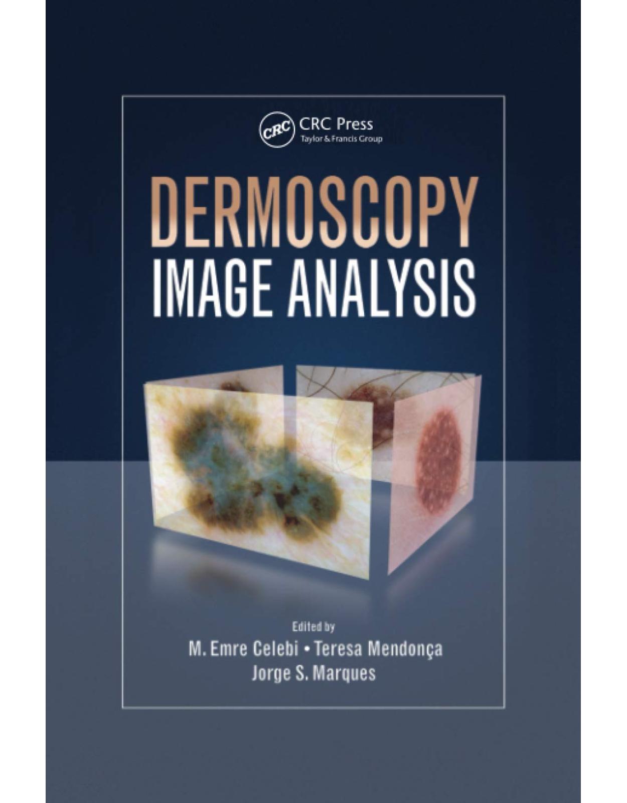 Dermoscopy Image Analysis 
