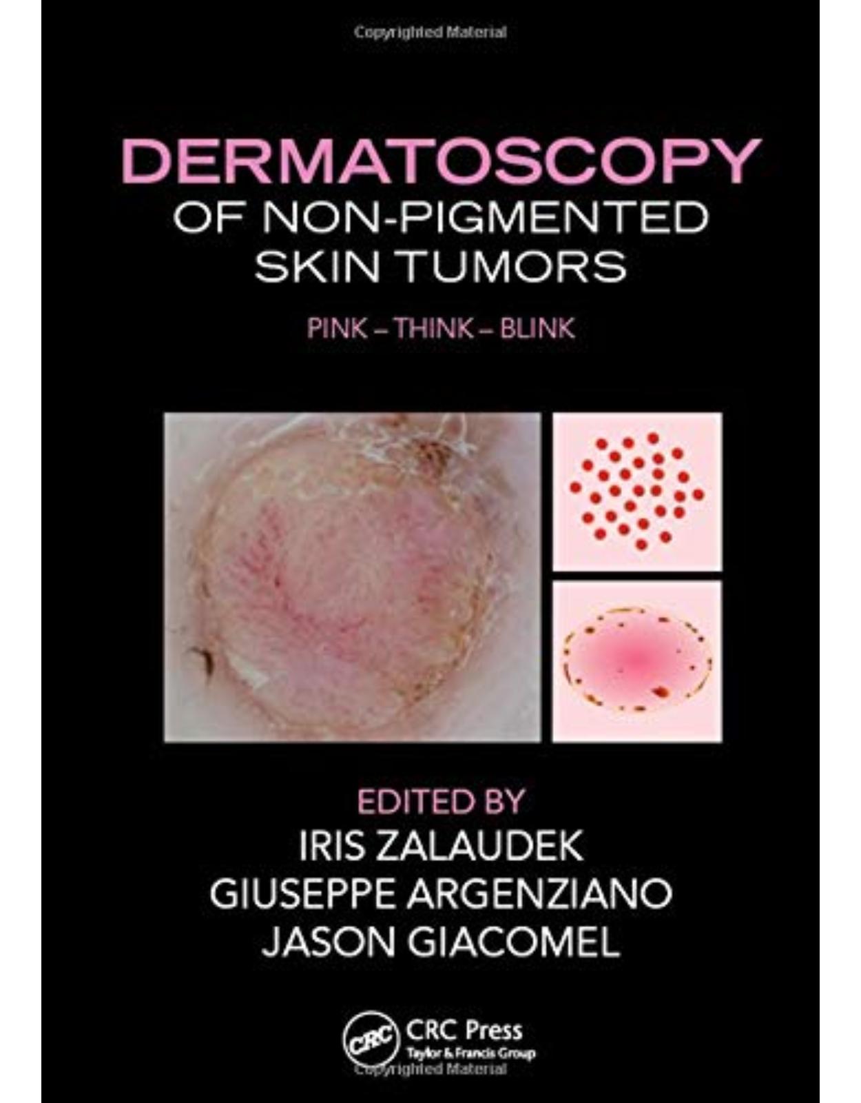 Dermatoscopy of Non-Pigmented Skin Tumors