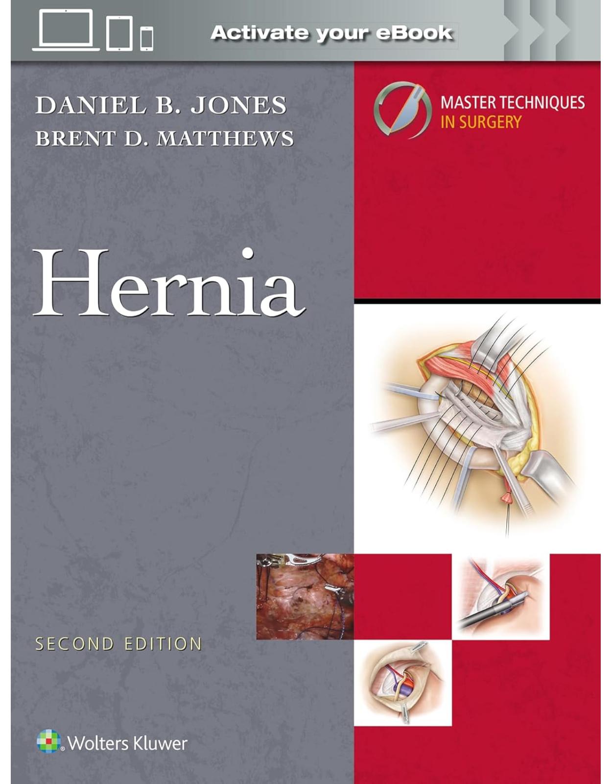 Master Techniques in Surgery: Hernia: Print + eBook with Multimedia. Second edition