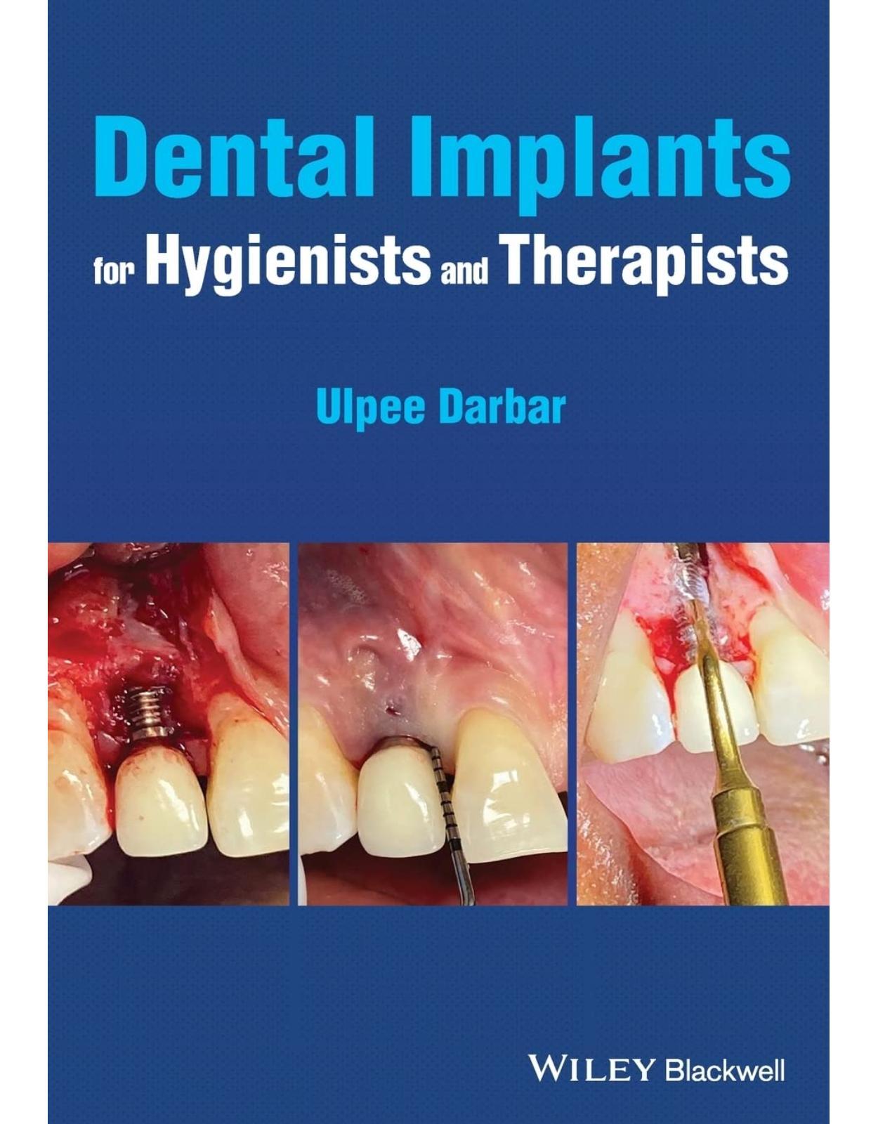 Dental Implants for Hygienists and Therapists