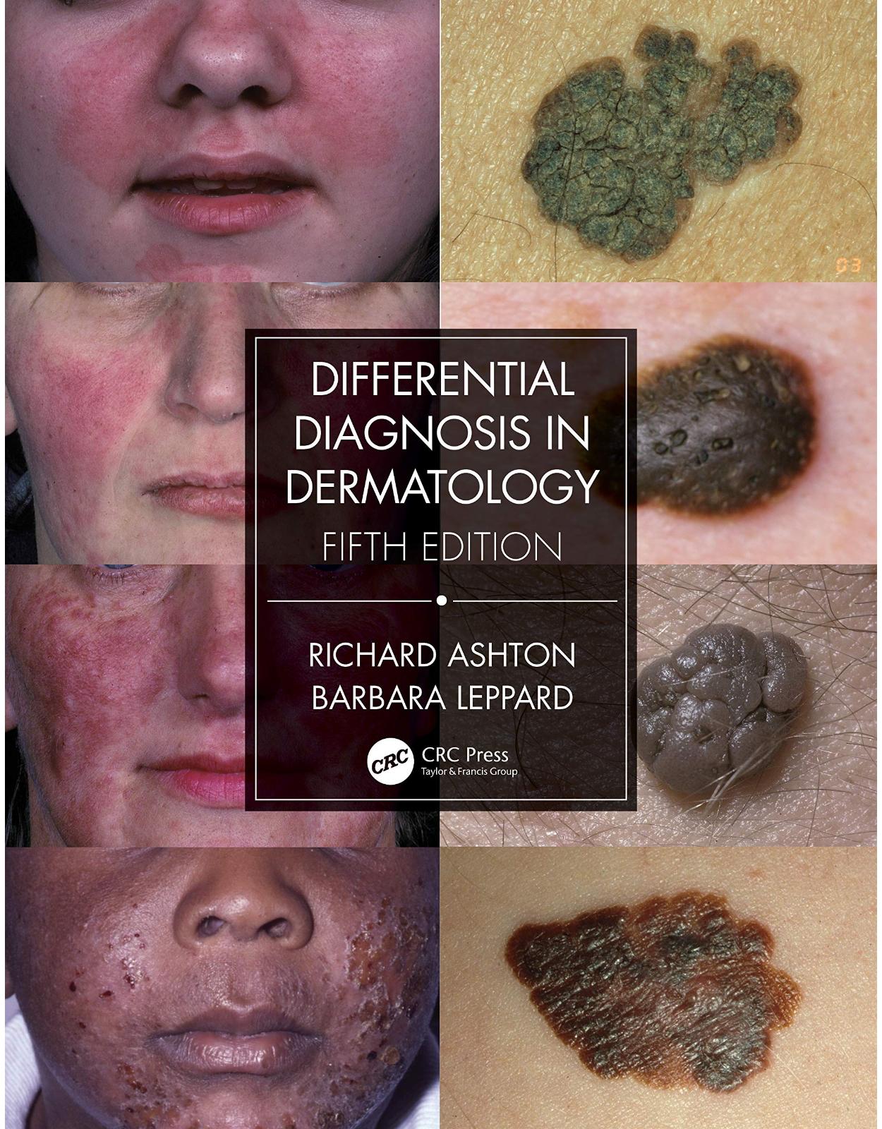 Differential Diagnosis in Dermatology