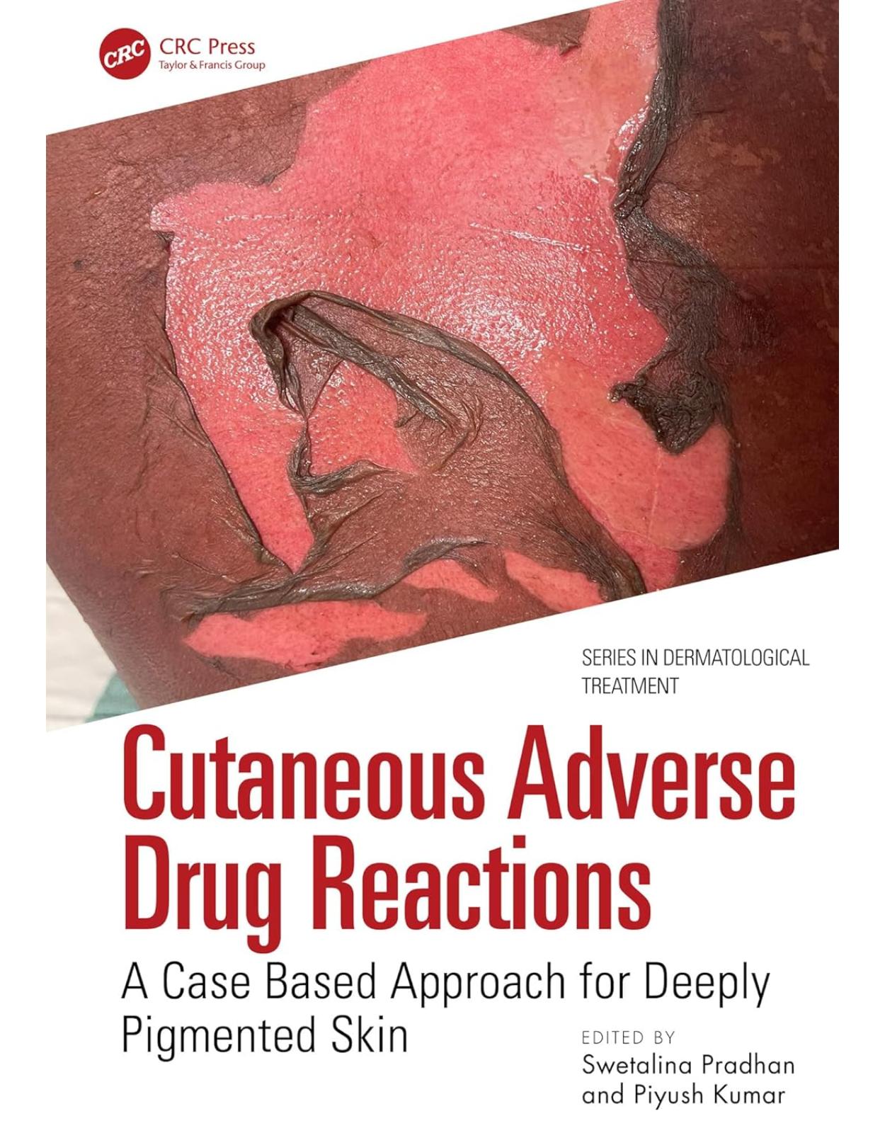 Cutaneous Adverse Drug Reactions. A Case Based Approach for Deeply Pigmented Skin