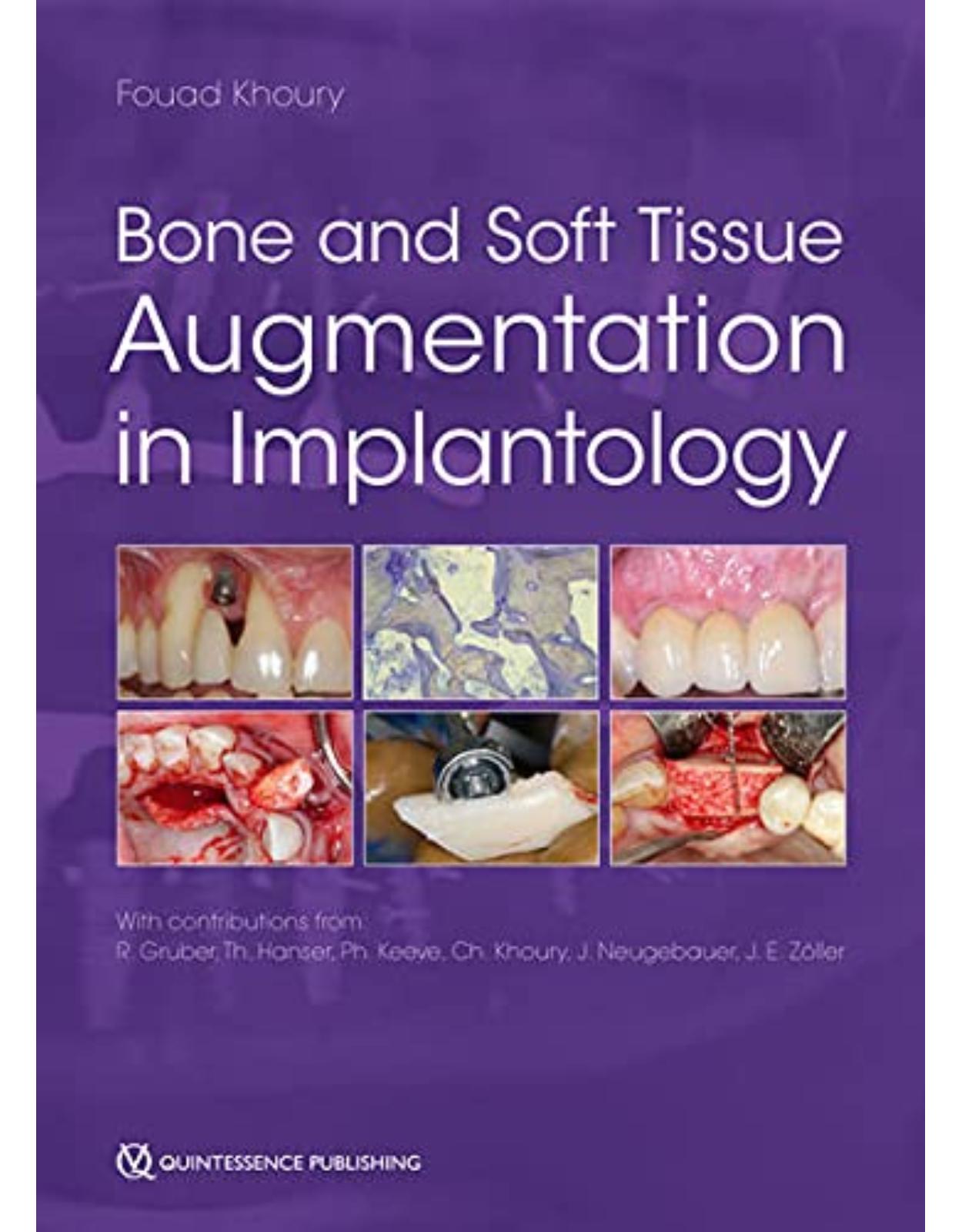 Bone and Soft Tissue Augmentation in Implantology