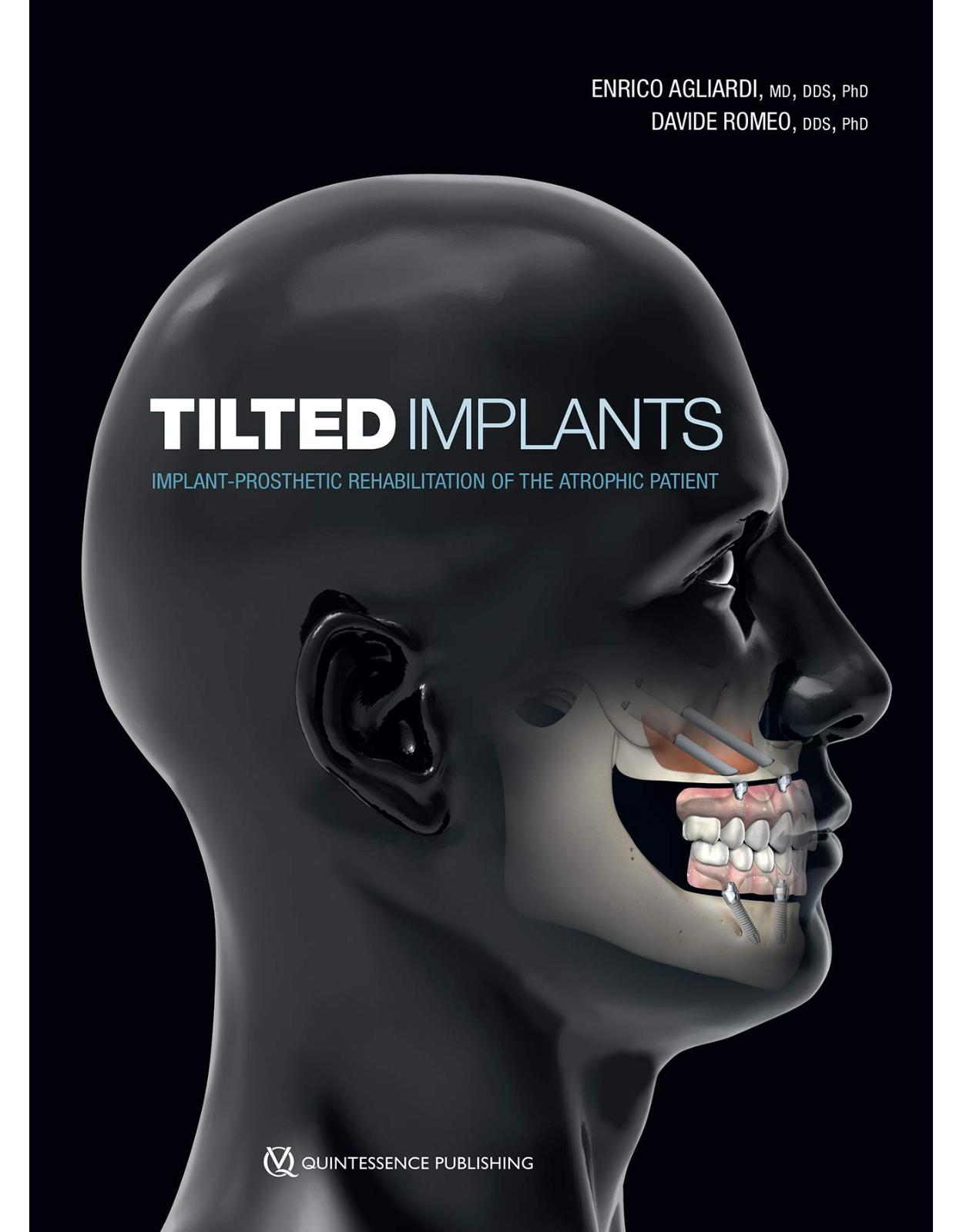 Tilted Implants: Implant-Prosthetic Rehabilitation of the Atrophic Patient