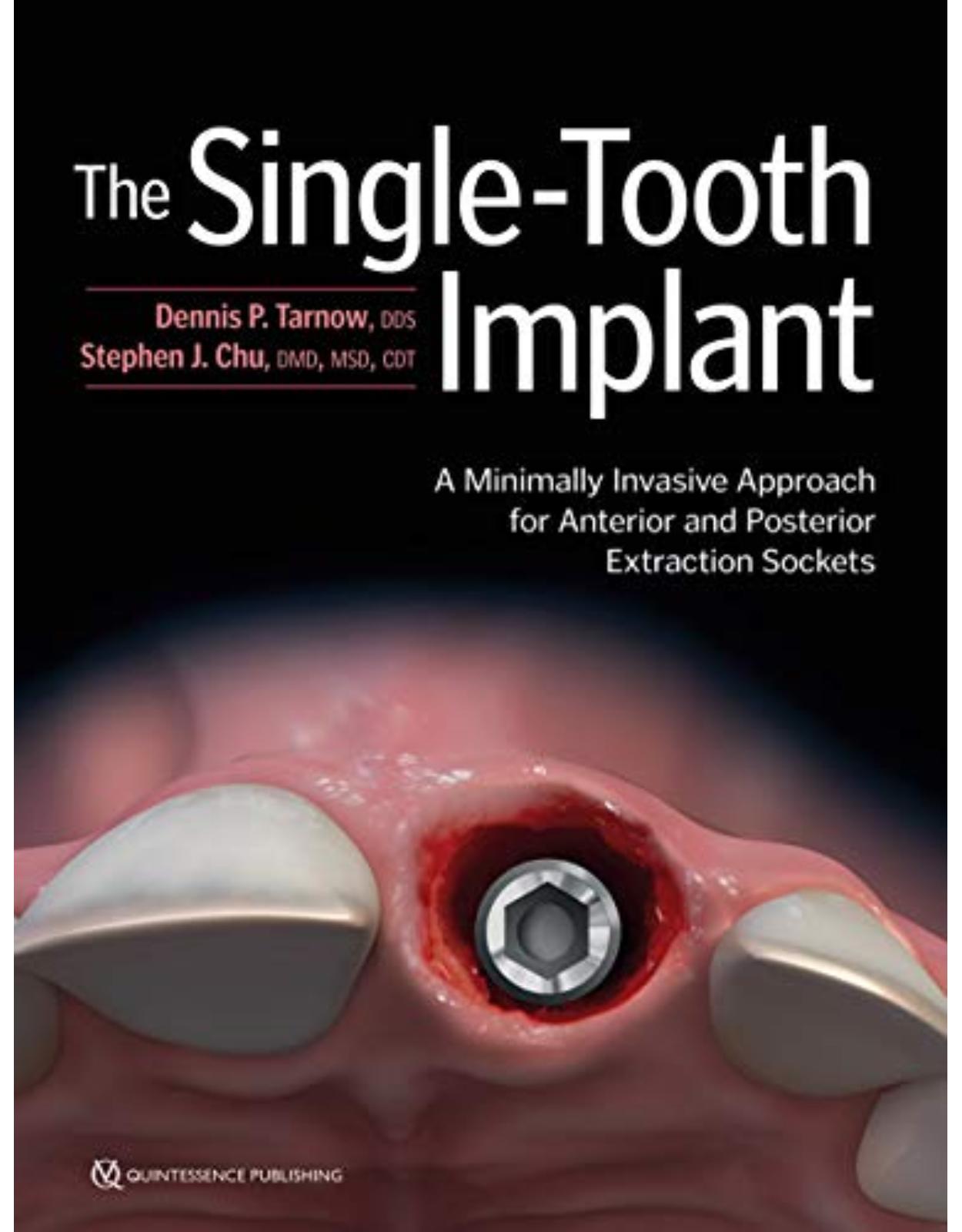 The Single-Tooth Implant: A Minimally Invasive Approach for Anterior and Posterior Extraction Sockets