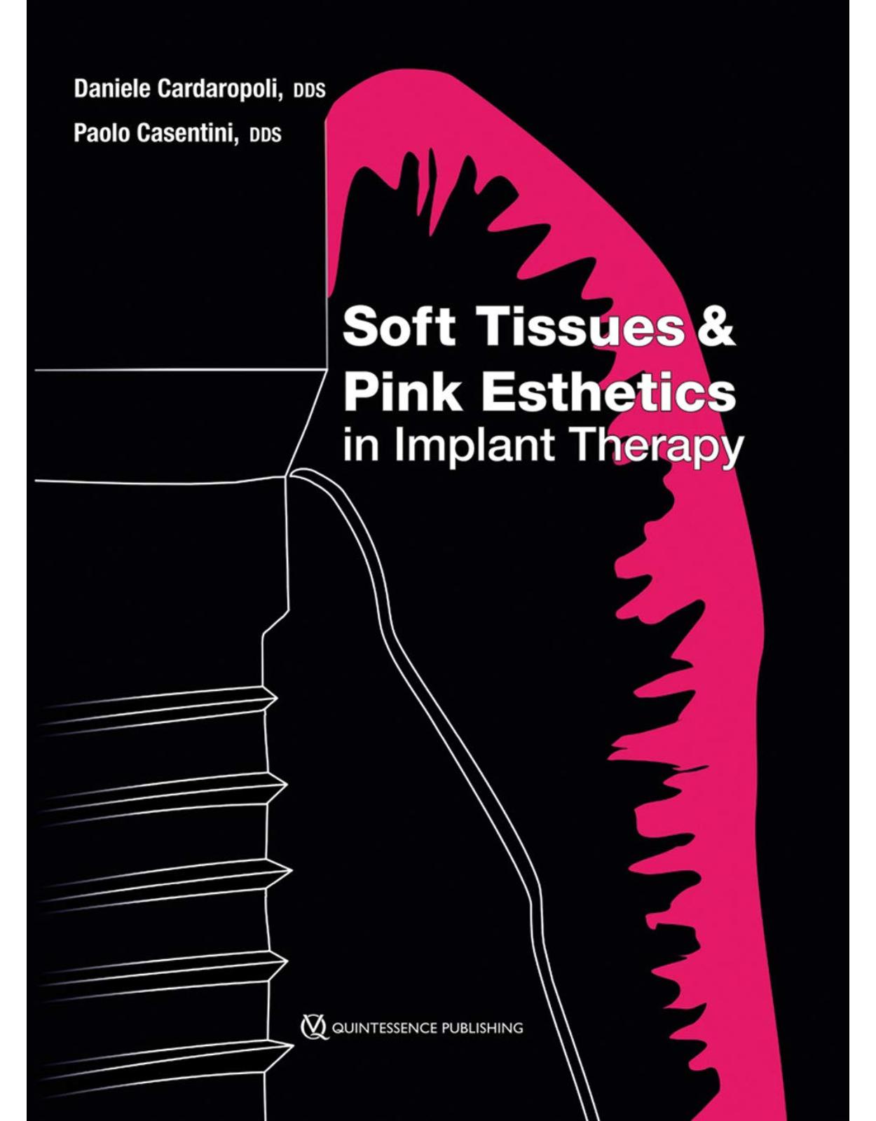 Soft Tissues and Pink Esthetics in Implant Therapy