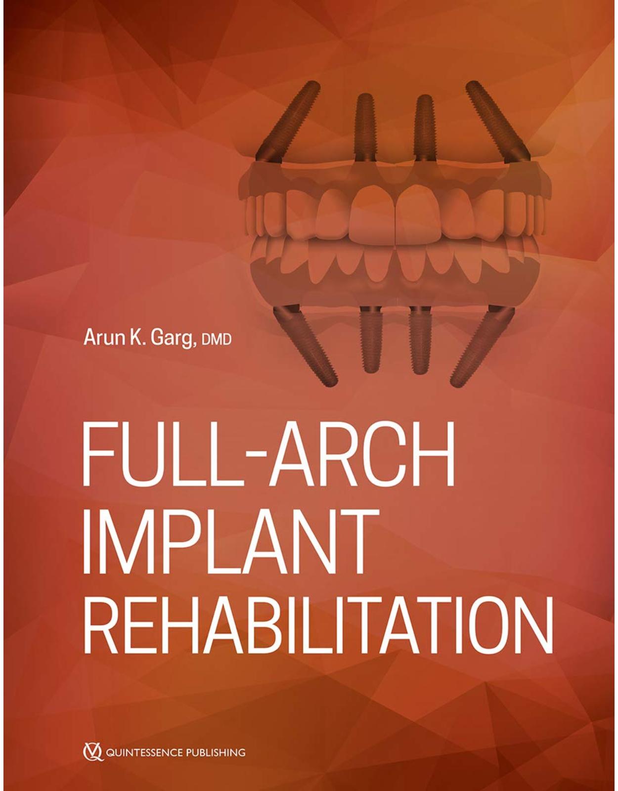 Full-Arch Implant Rehabilitation