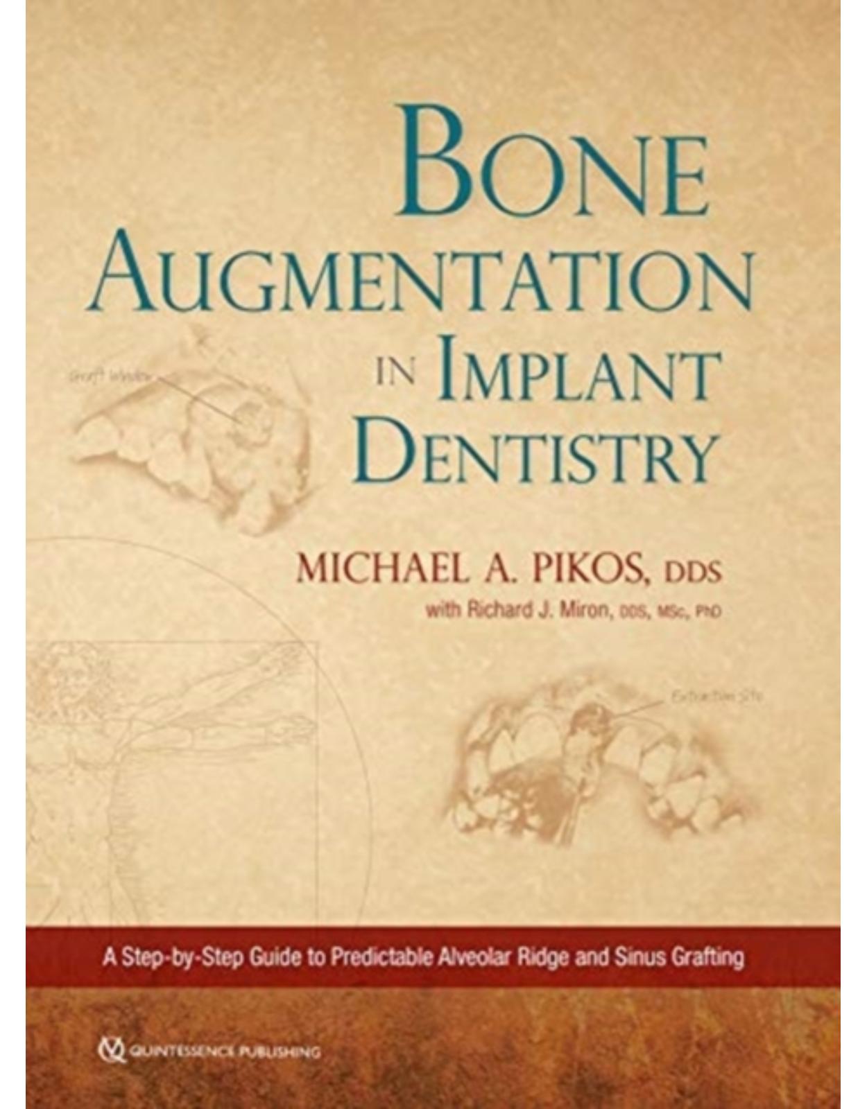 Bone Augmentation in Implant Dentistry: A Step-by-Step Guide to Predictable Alveolar Ridge and Sinus Grafting