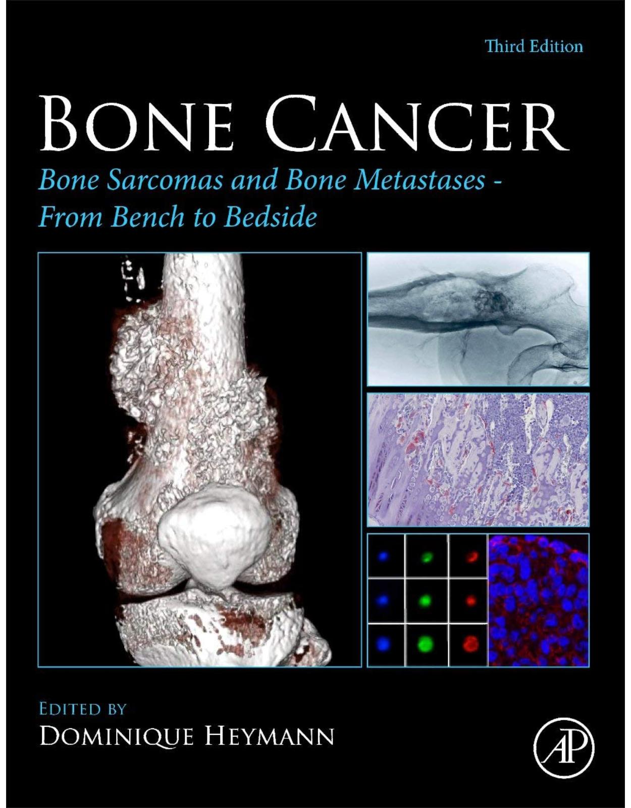 Bone Cancer