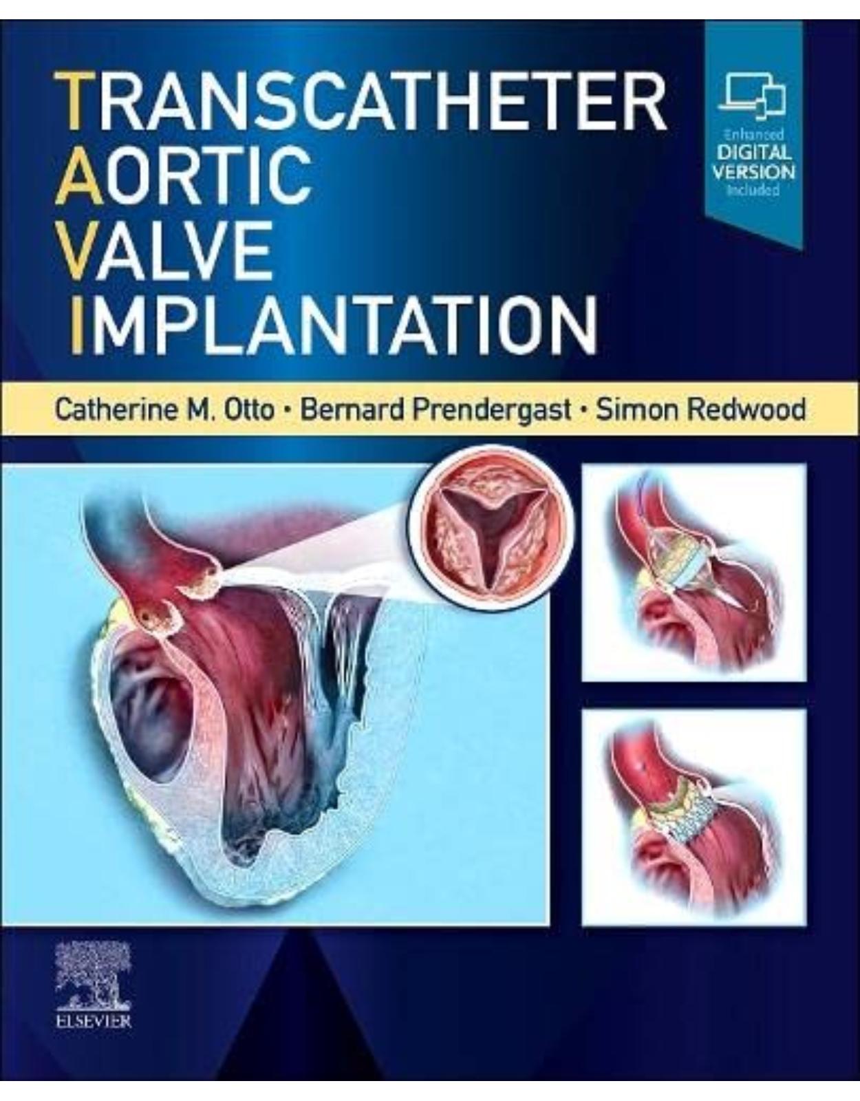 Transcatheter Aortic Valve Implantation 