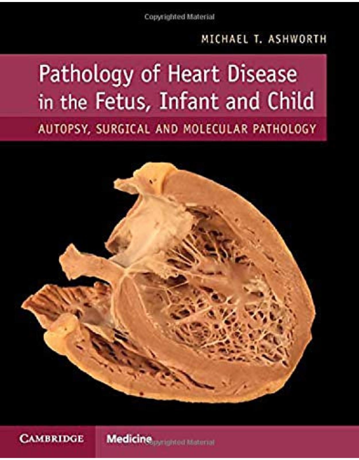 Pathology of Heart Disease in the Fetus, Infant and Child