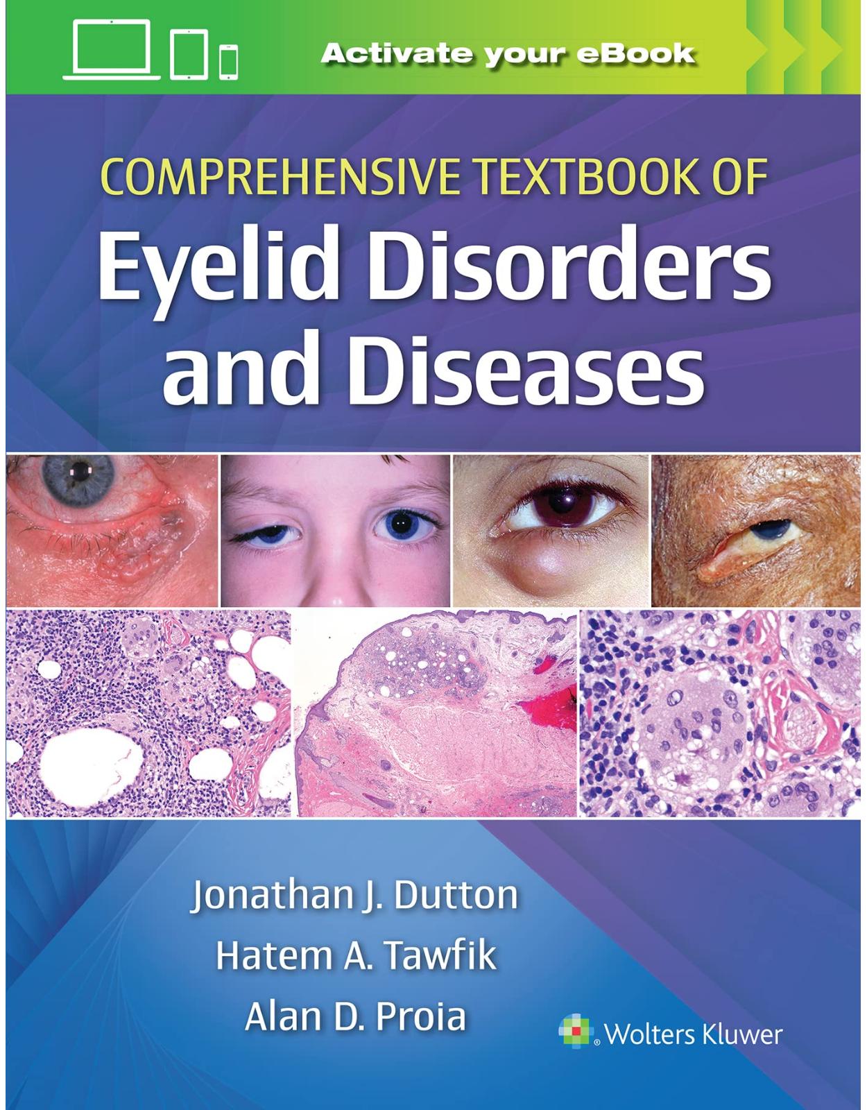 Comprehensive Textbook of Eyelid Disorders