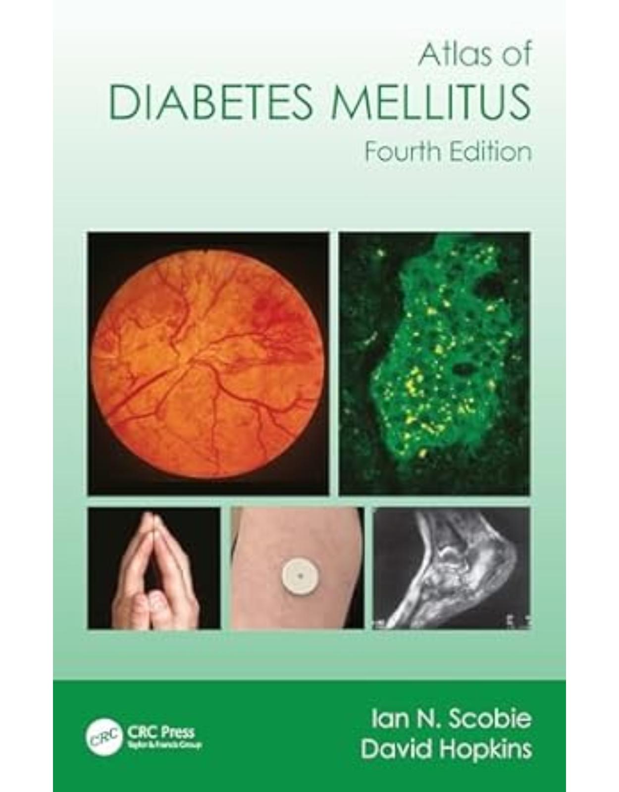 Atlas of Diabetes Mellitus