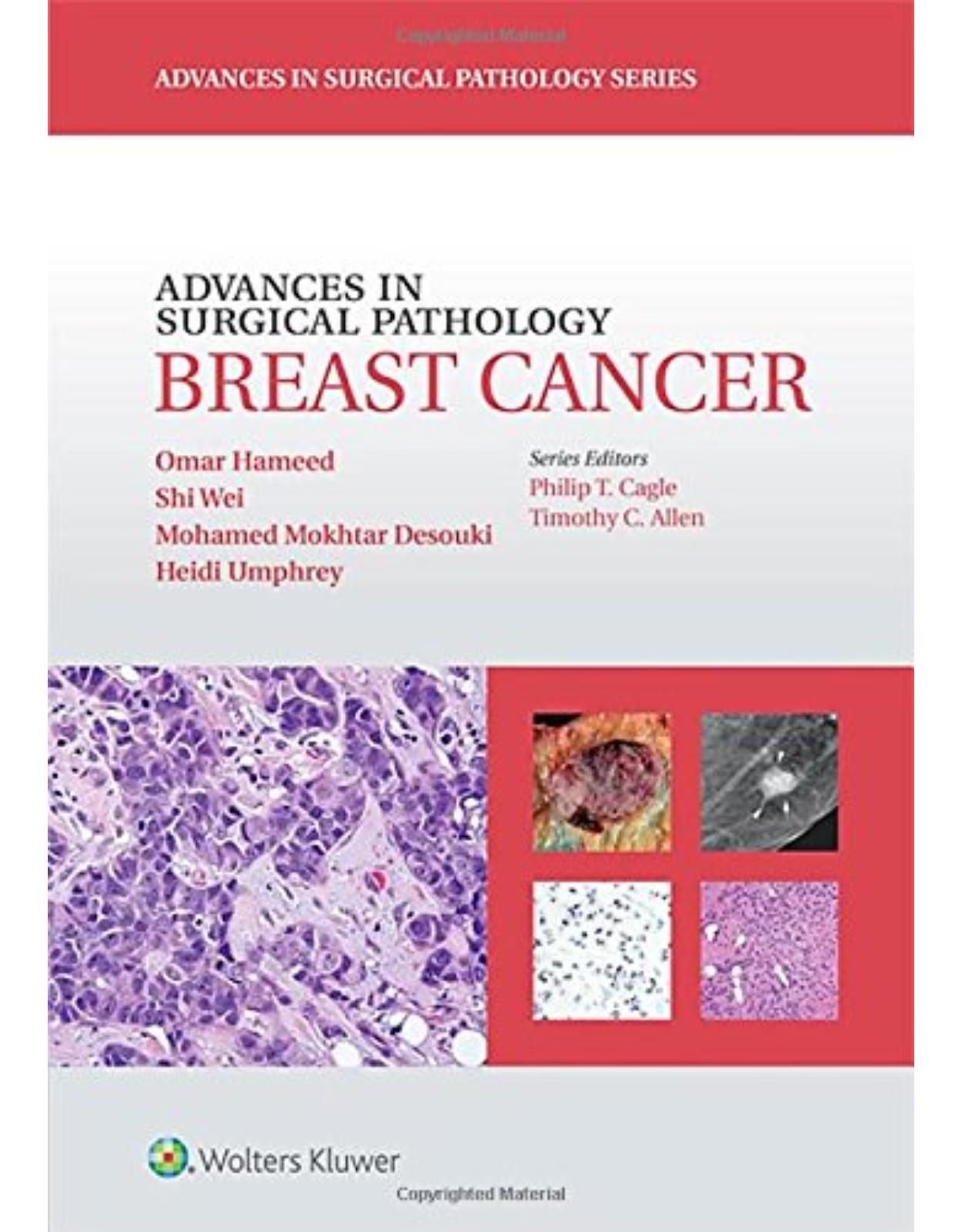Advances in Surgical Pathology: Breast Cancer