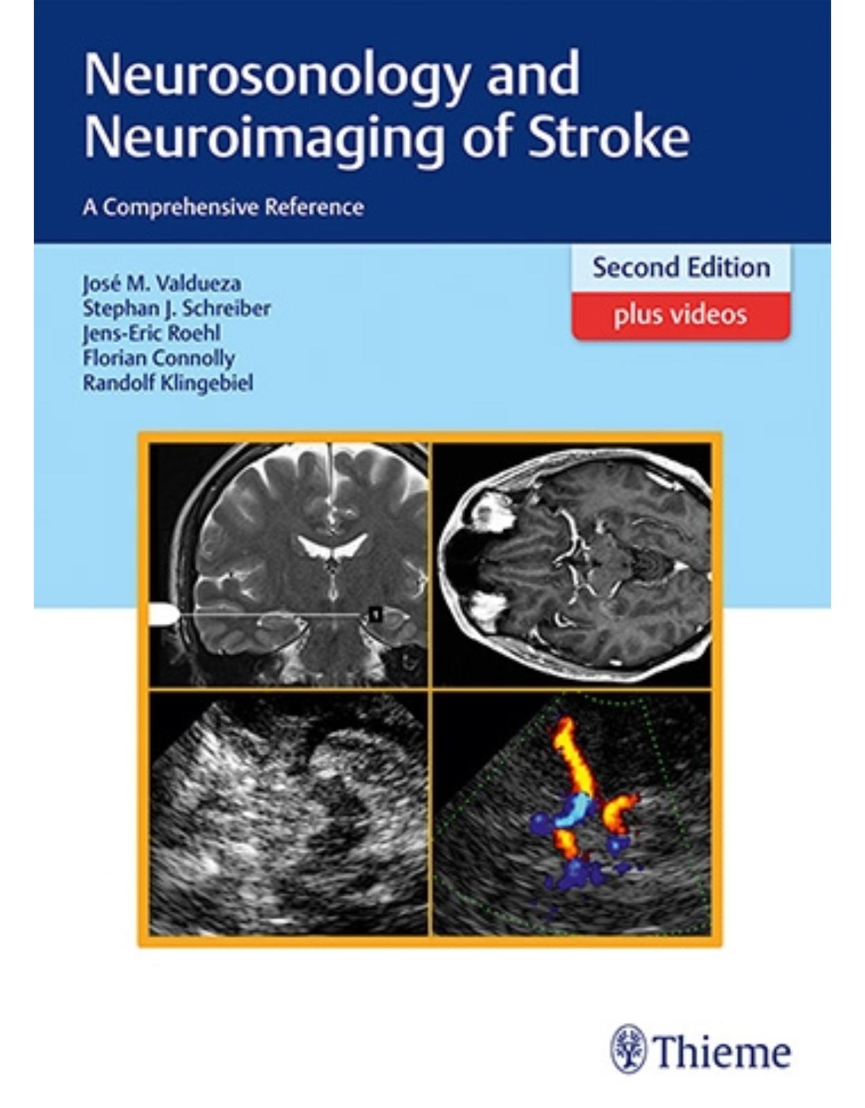 Neurosonology and Neuroimaging of Stroke: A Comprehensive Reference