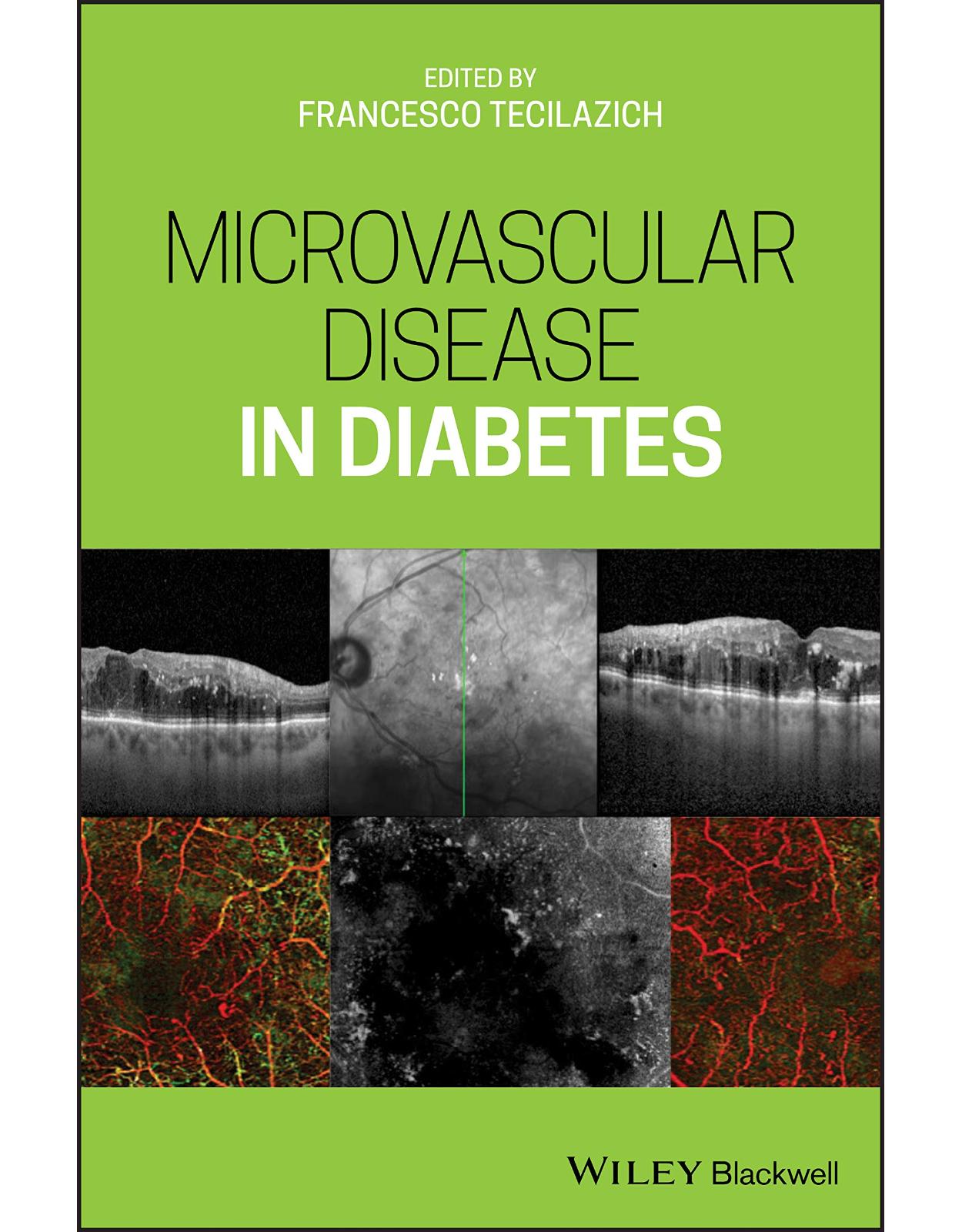 Microvascular Disease in Diabetes