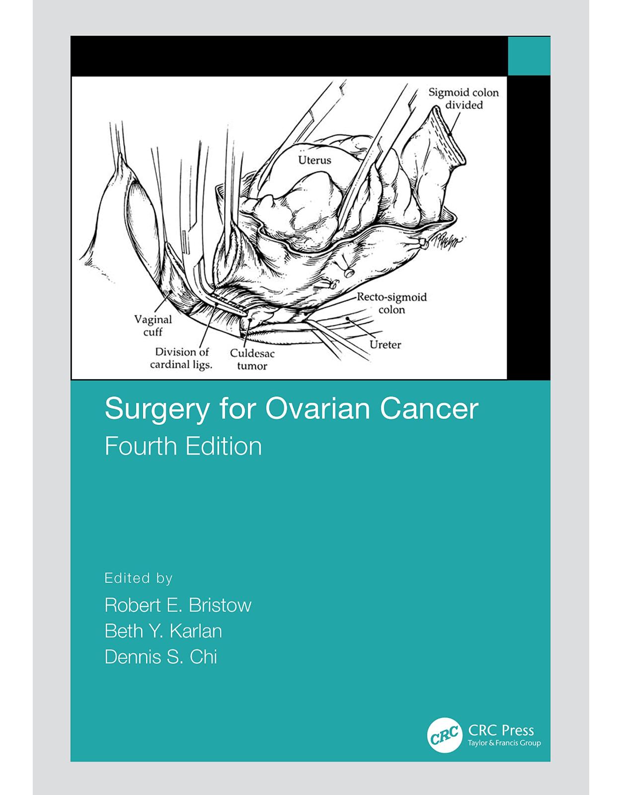 Surgery for Ovarian Cancer