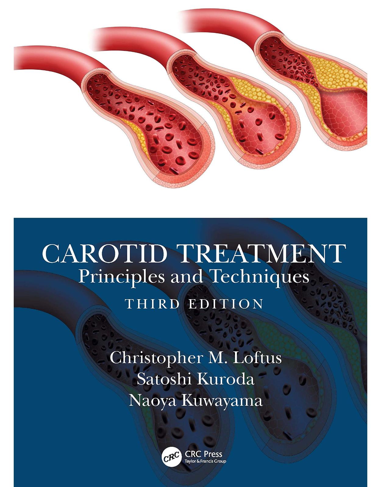Carotid Treatment: Principles and Techniques