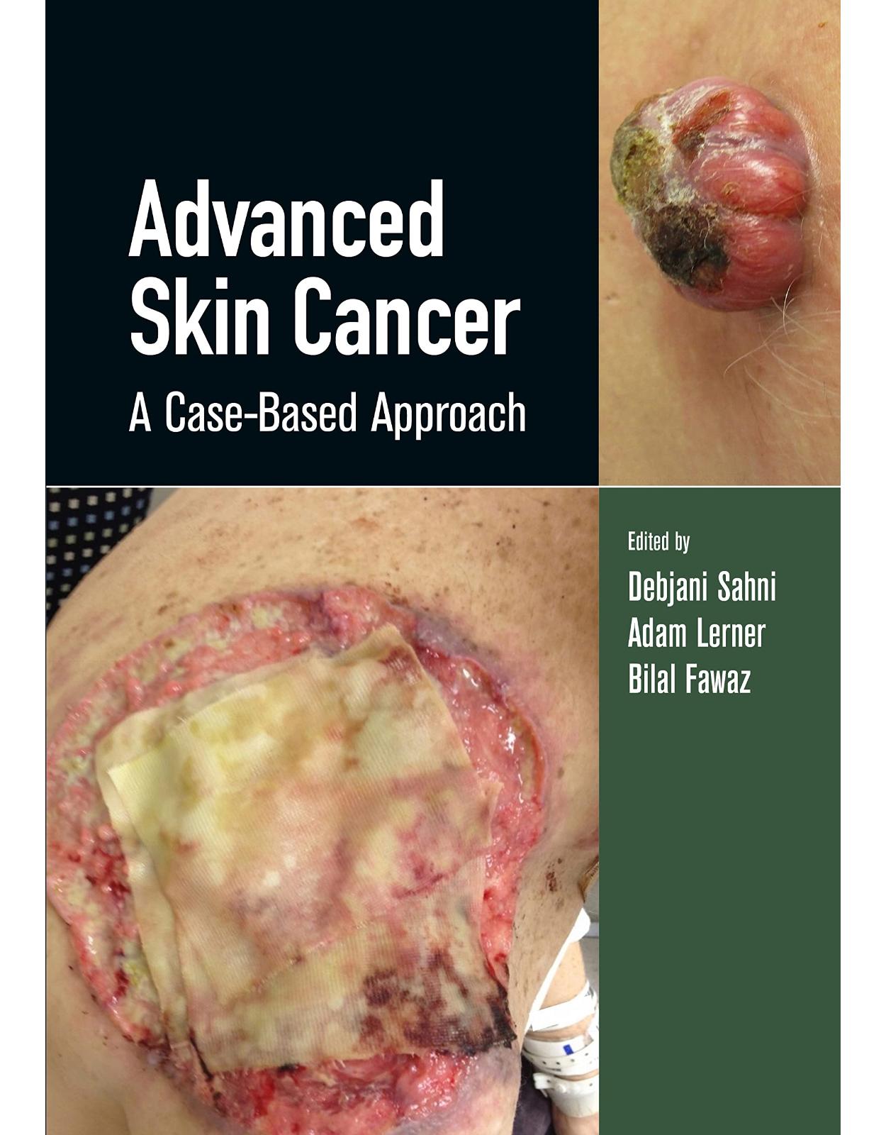 Advanced Skin Cancer: A Case-Based Approach