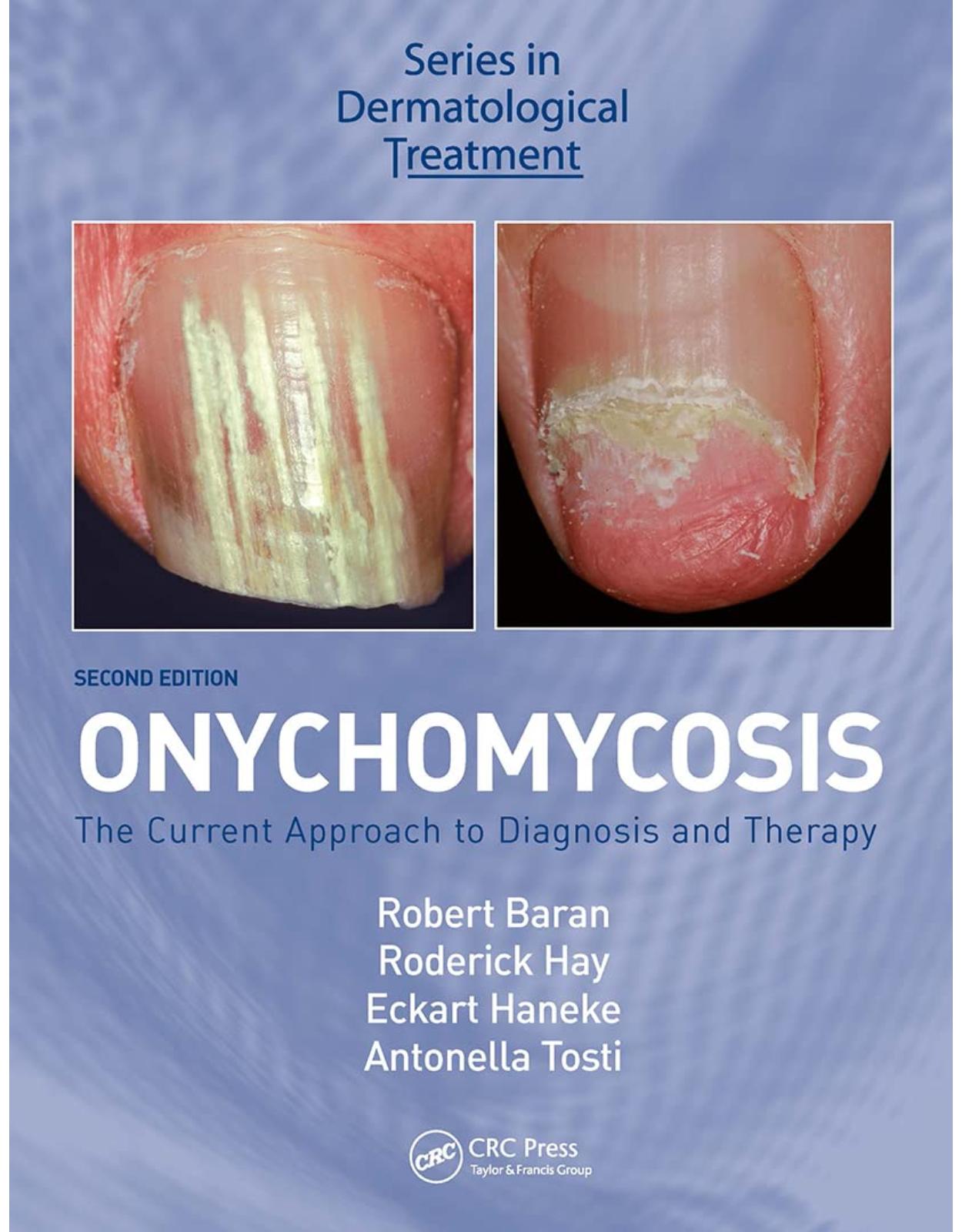 Onychomycosis: The Current Approach to Diagnosis and Therapy