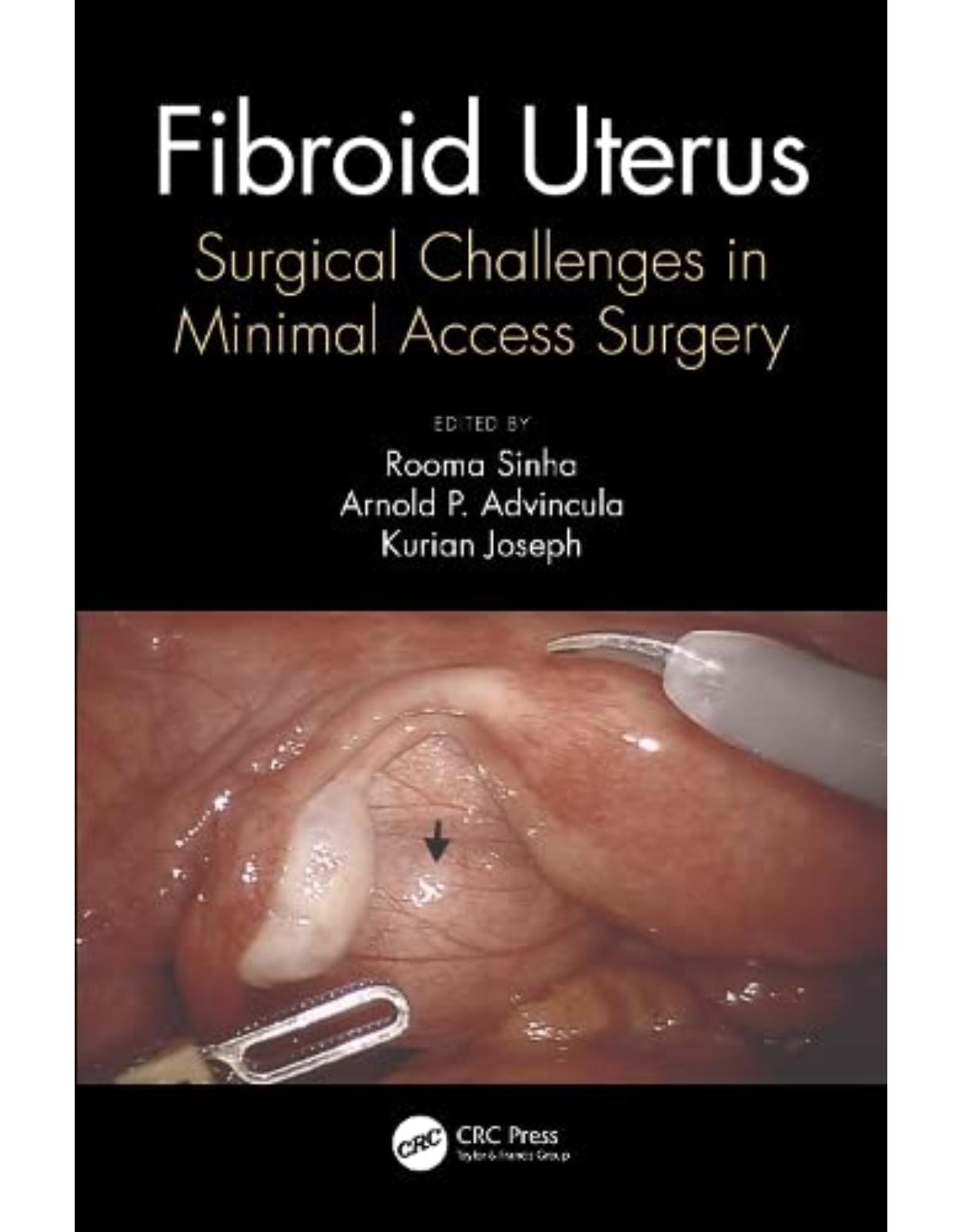 Fibroid Uterus: Surgical Challenges in Minimal Access Surgery