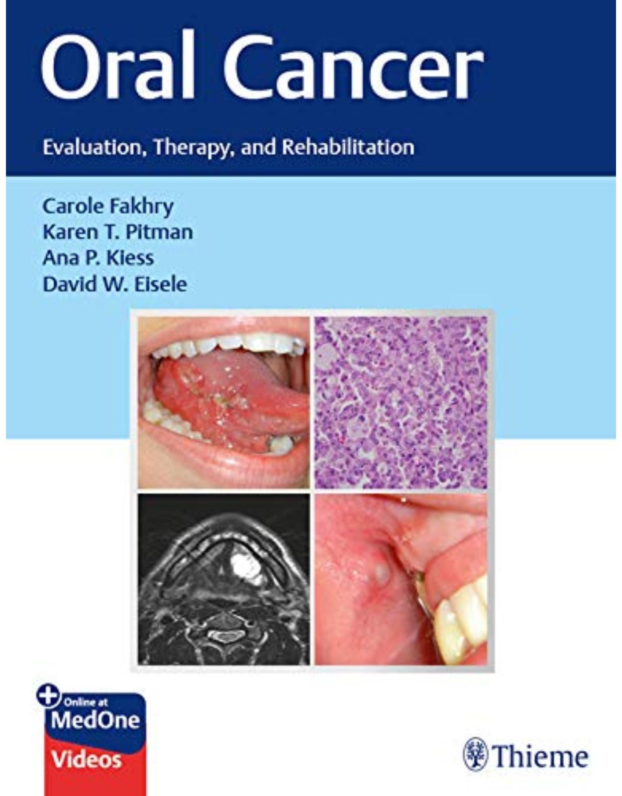 Oral Cancer: Evaluation, Therapy, and Rehabilitation