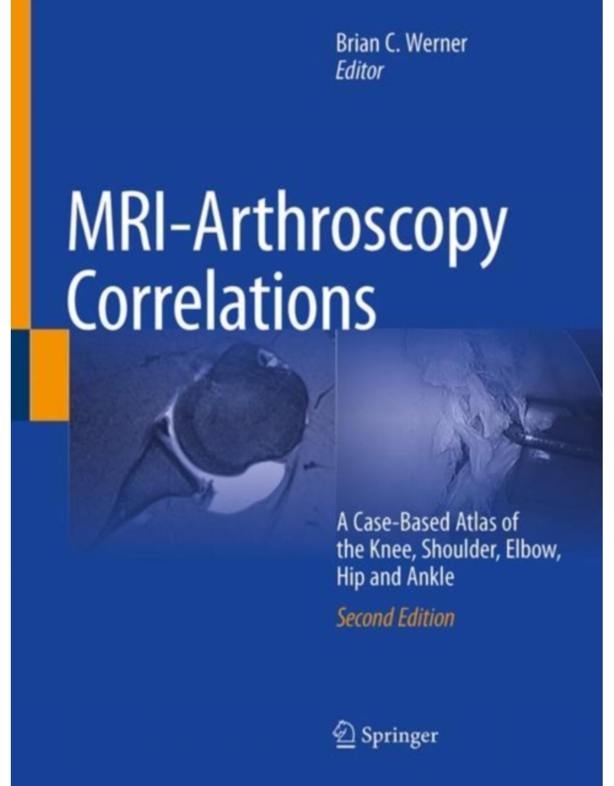 MRI-Arthroscopy Correlations