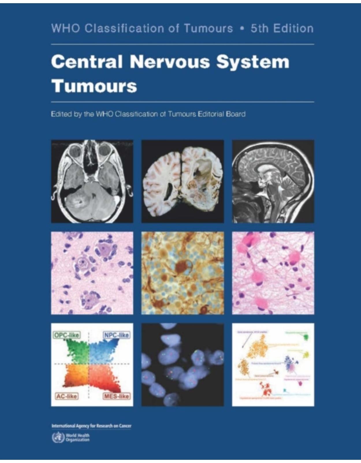 Central Nervous System Tumours: Who Classification of Tumours 