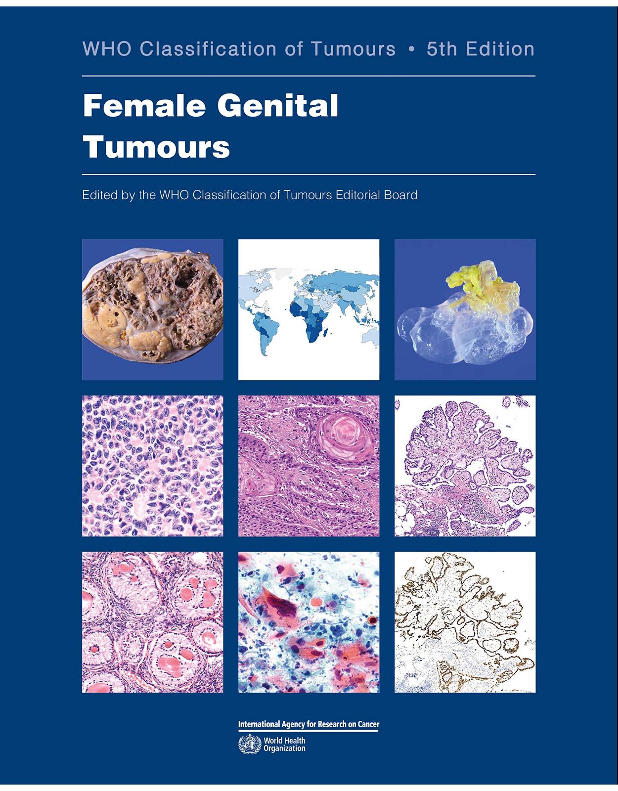 WHO classification of female genital tumours: Who Classification of Tumours 