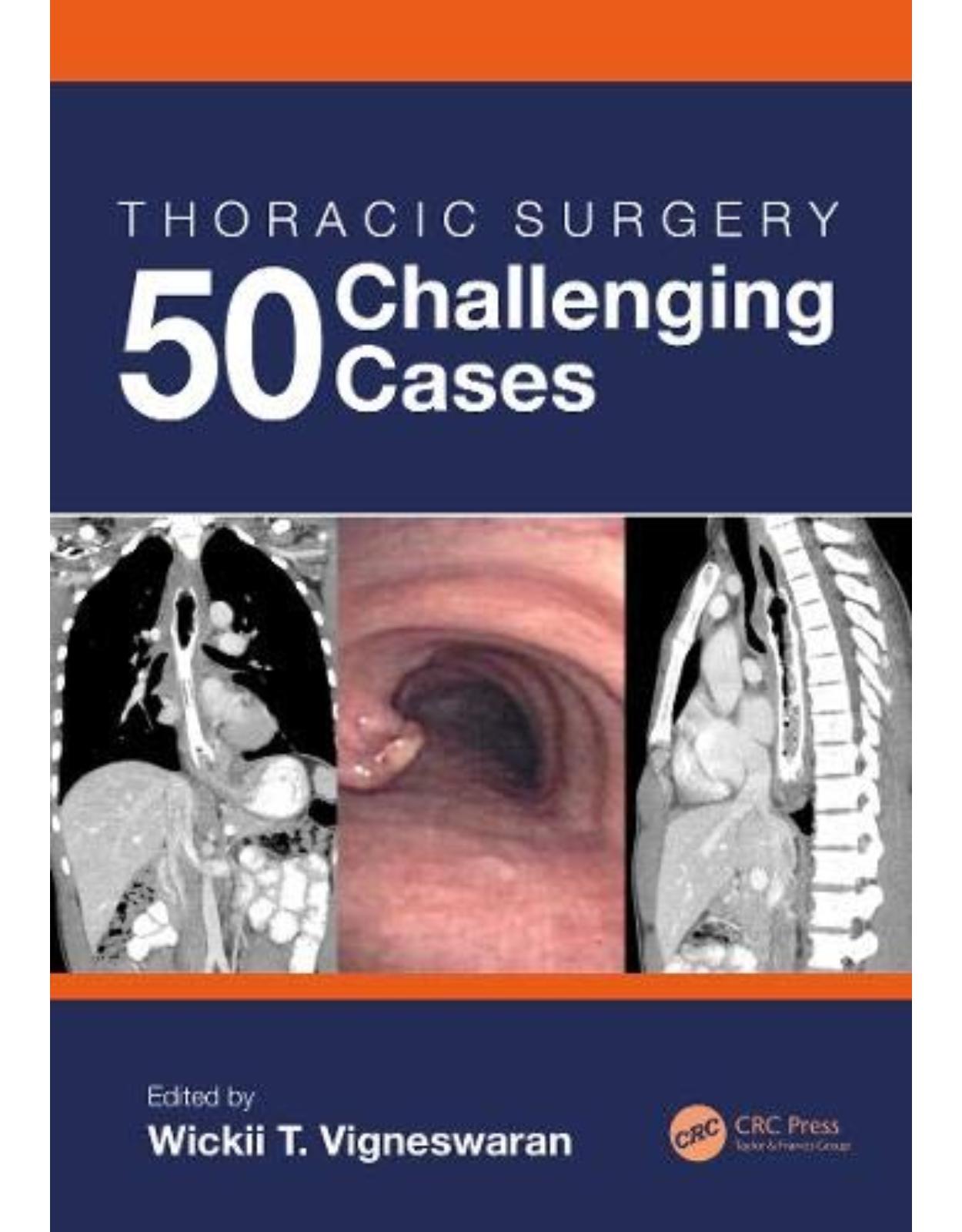 Thoracic Surgery: 50 Challenging cases