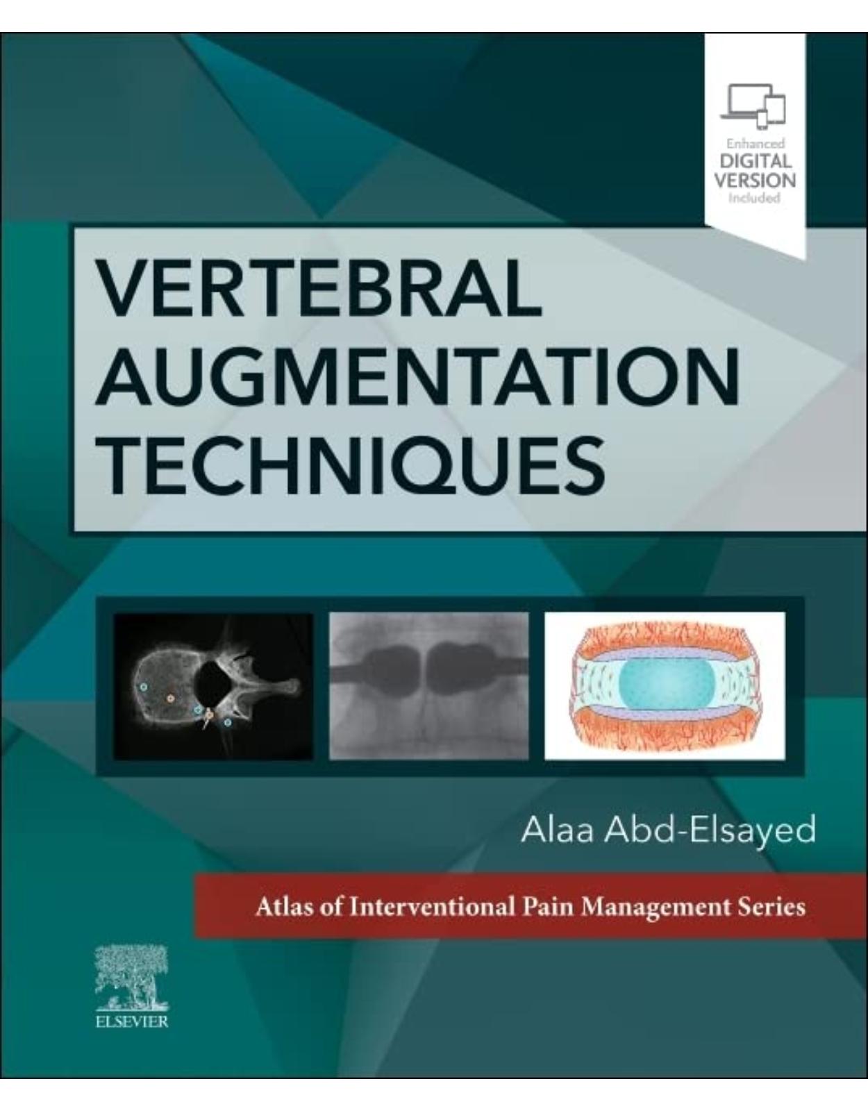 Vertebral Augmentation Techniques