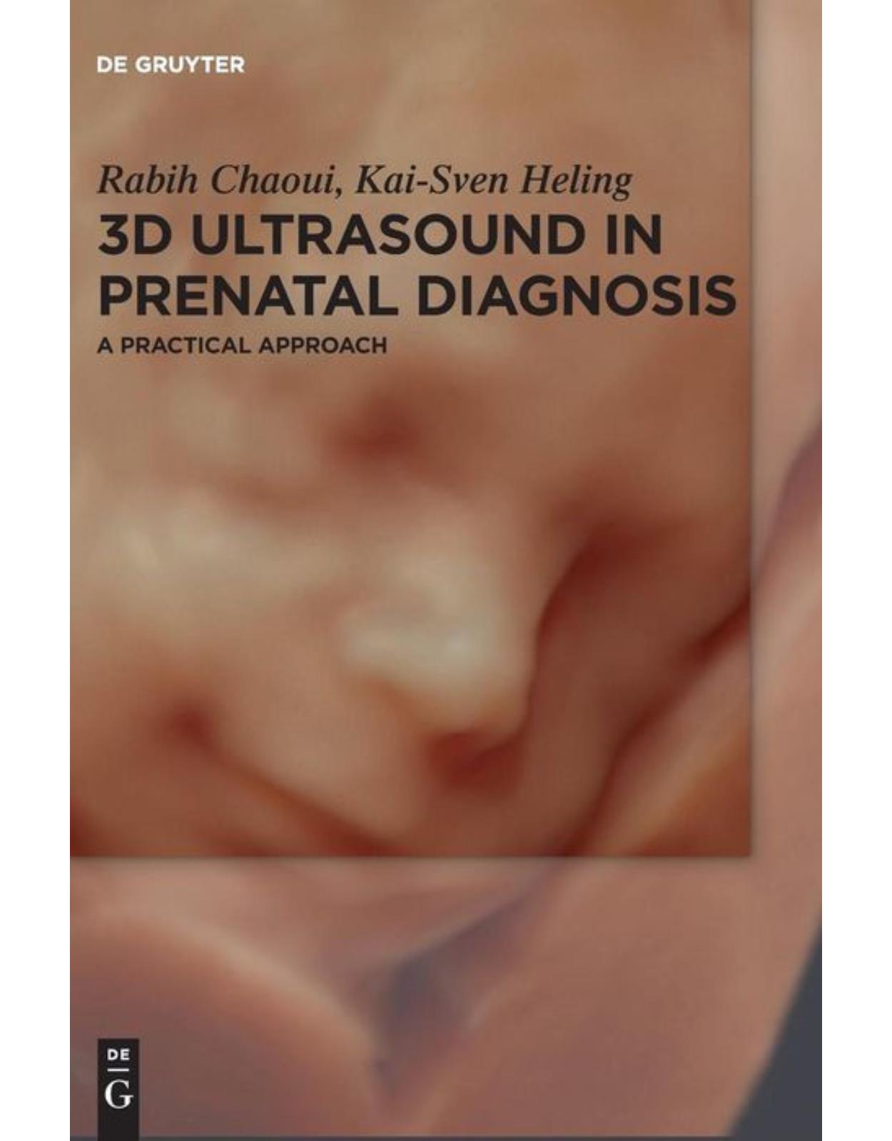 3D Ultrasound in Prenatal Diagnosis