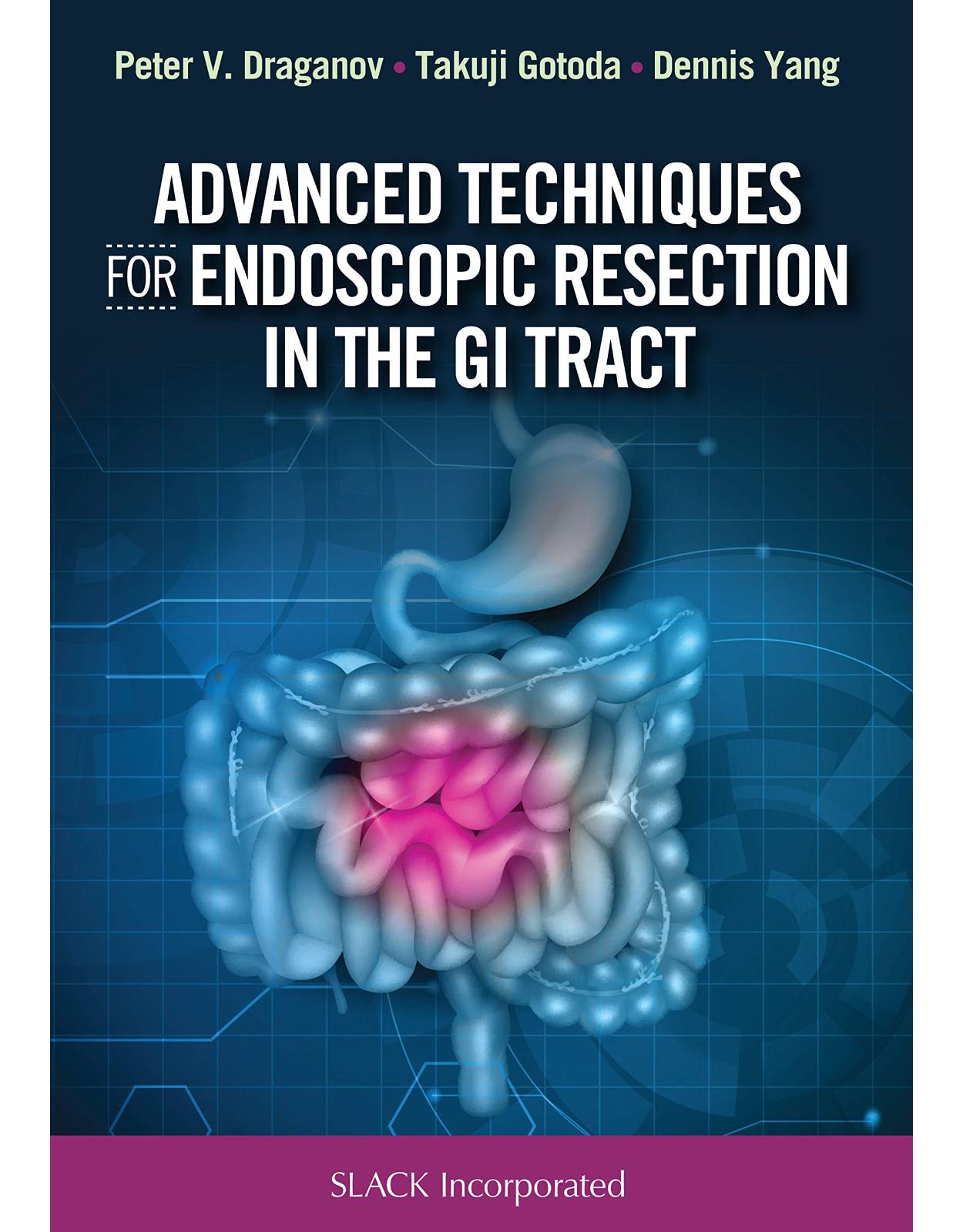 Advanced Techniques for Endoscopic Resection in the GI Tract 